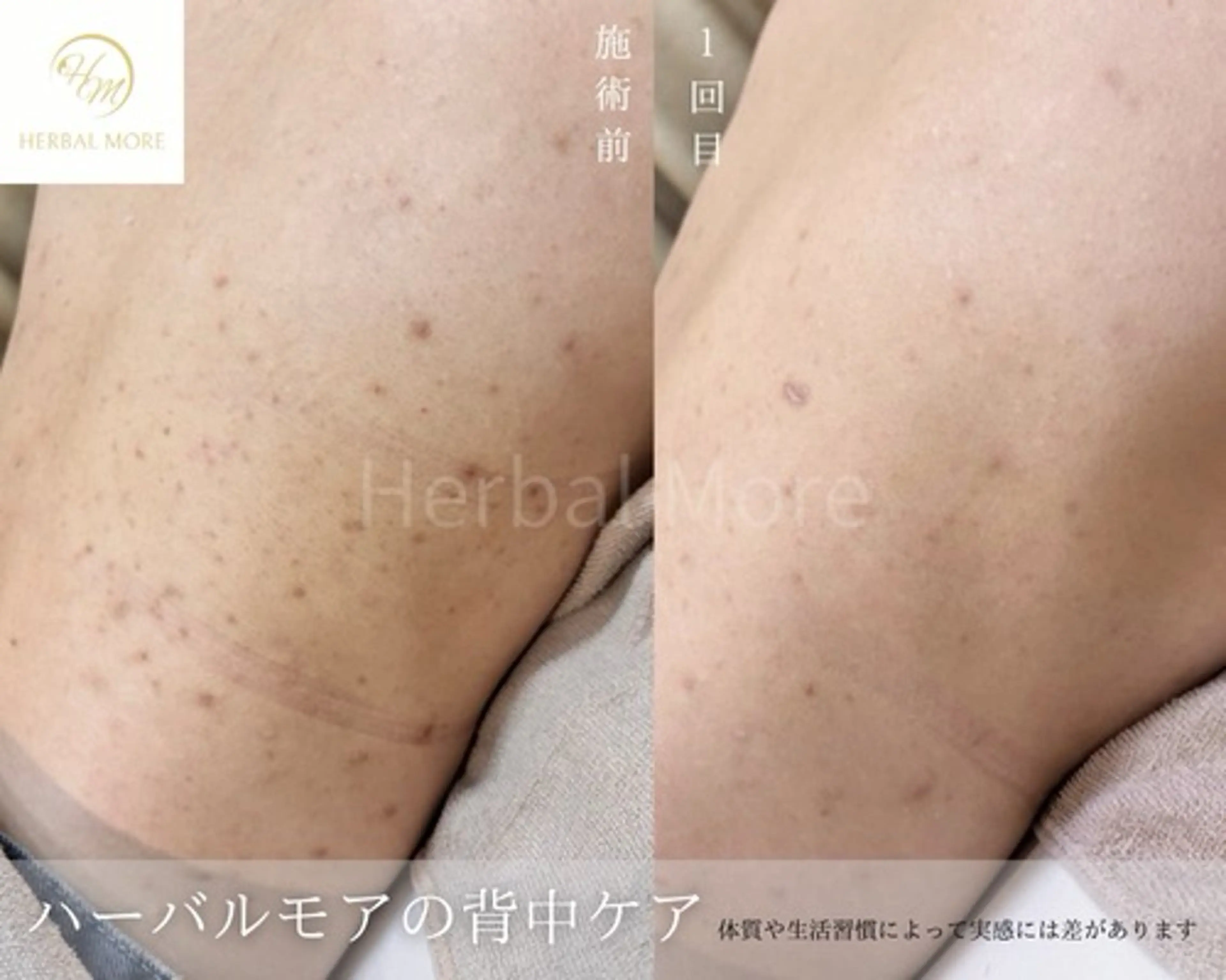 61%OFF《先着5名様限定》最高品質剥けるハーブピーリング×鎮静ケア《体用》の写真