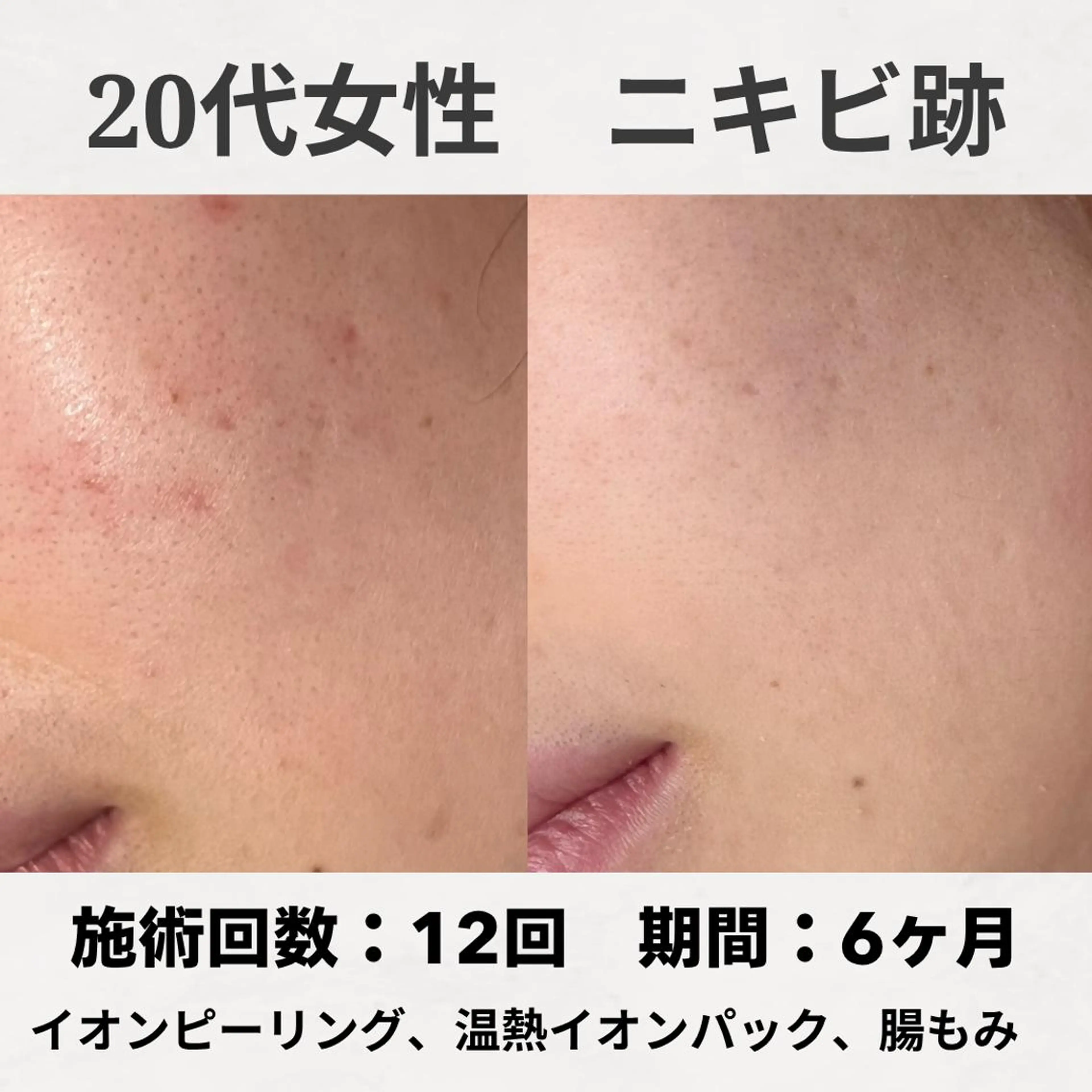 エステ リラク ニキビ跡改善専門🔥 医療にはできない改善のエステ・リラクイメージ