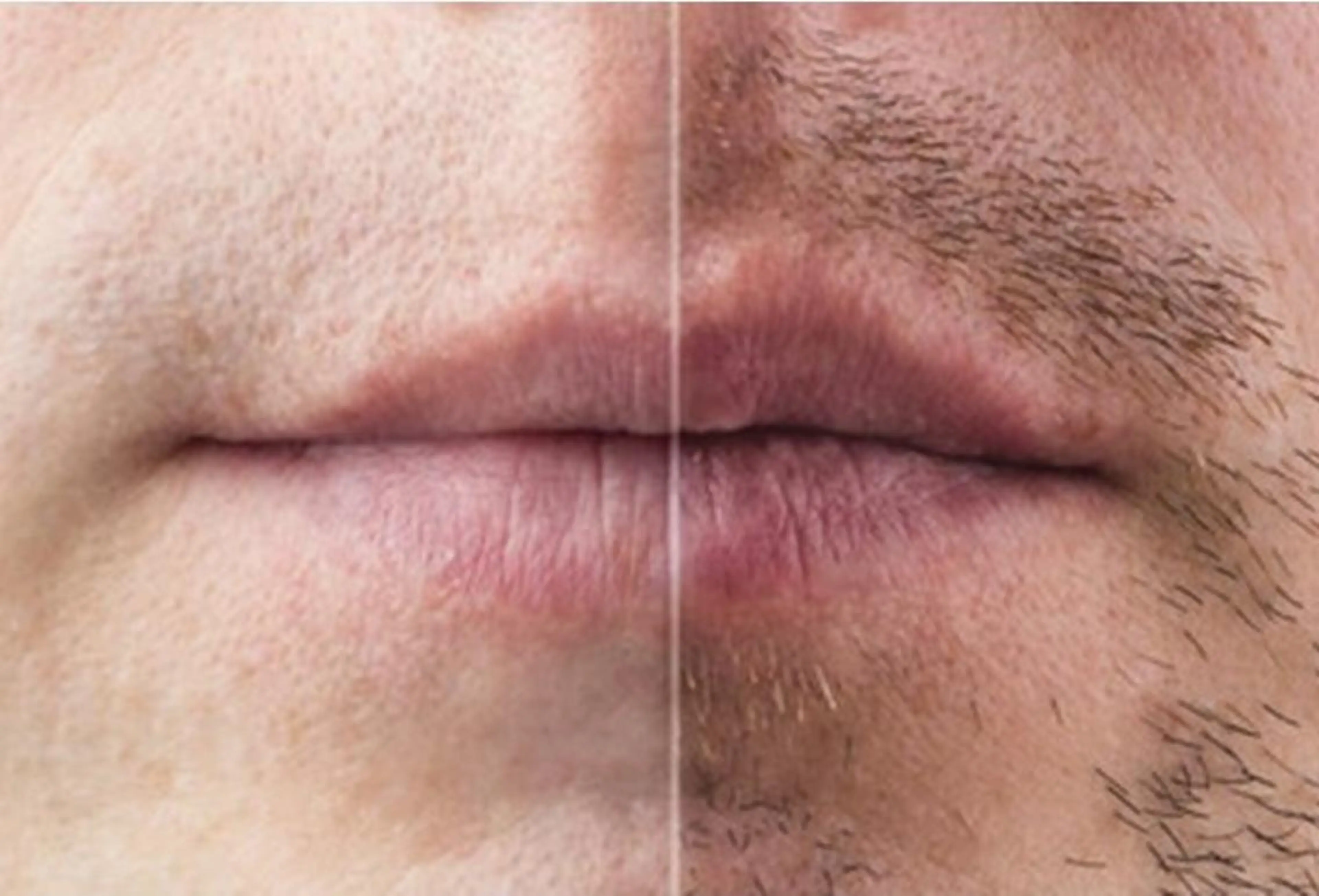 【メンズ脱毛】ピンポイント1本処理の1回完了脱毛/1本¥200×20本¥4000→¥999の写真