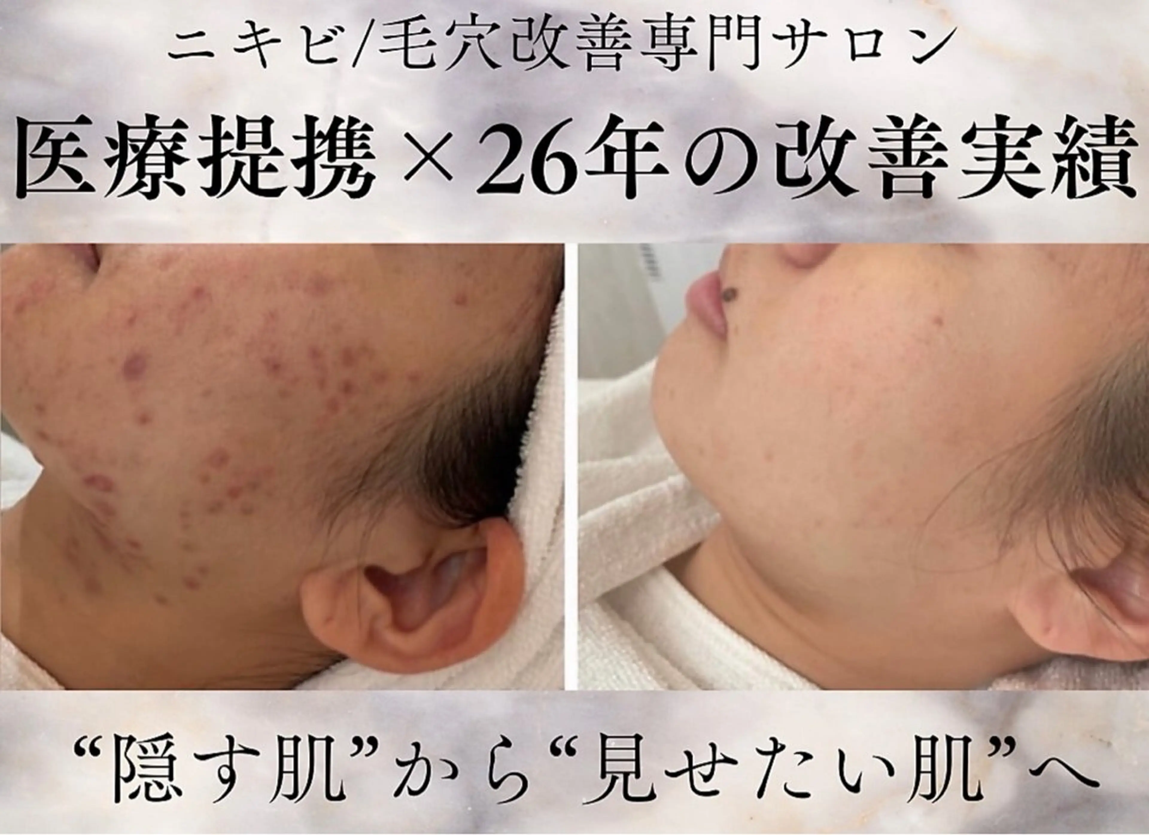 医療提携/ニキビ毛穴 サロンドエクラ南堀江のエステ・リラクイメージ