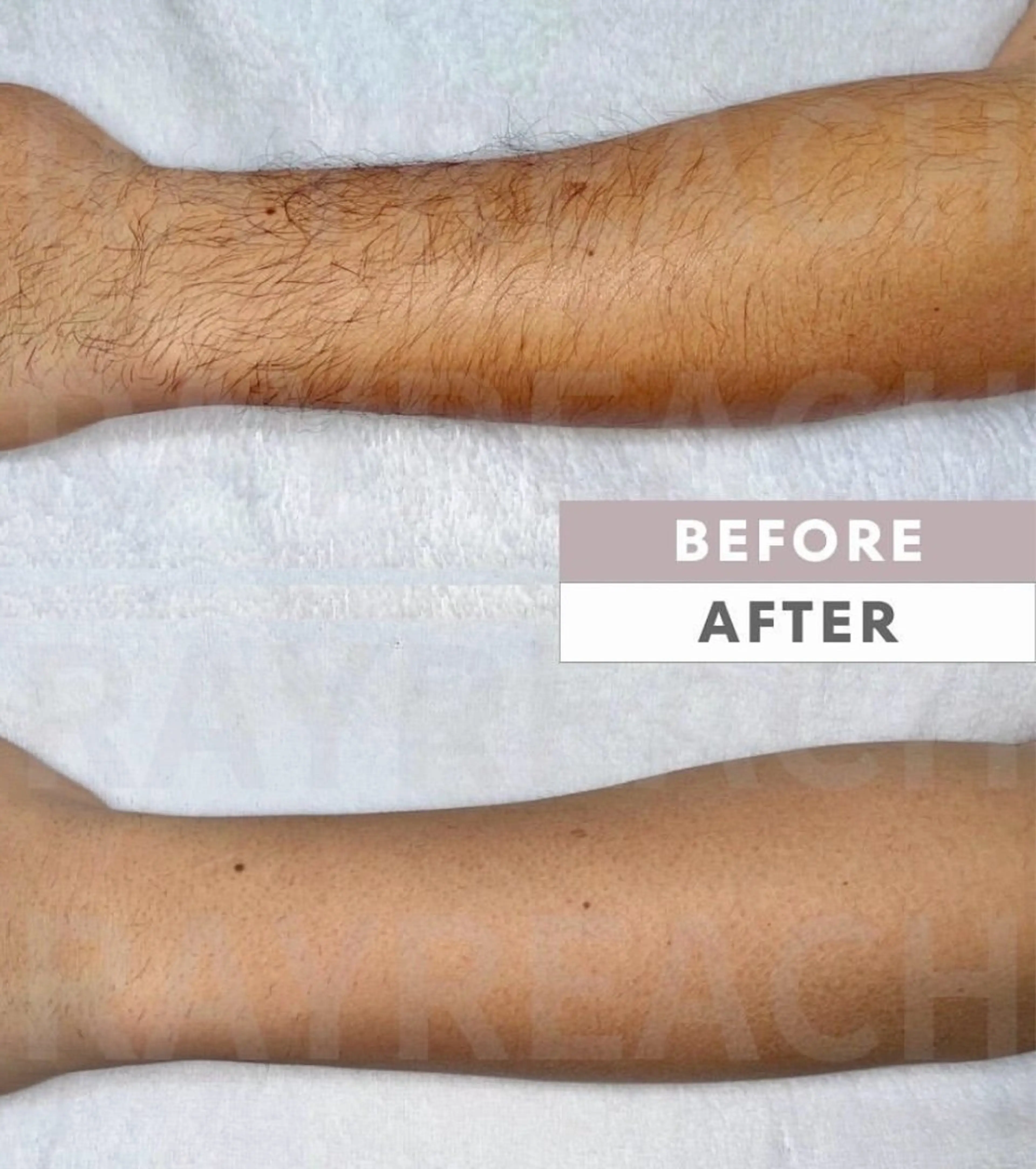 メンズ脱毛 両腕!の写真