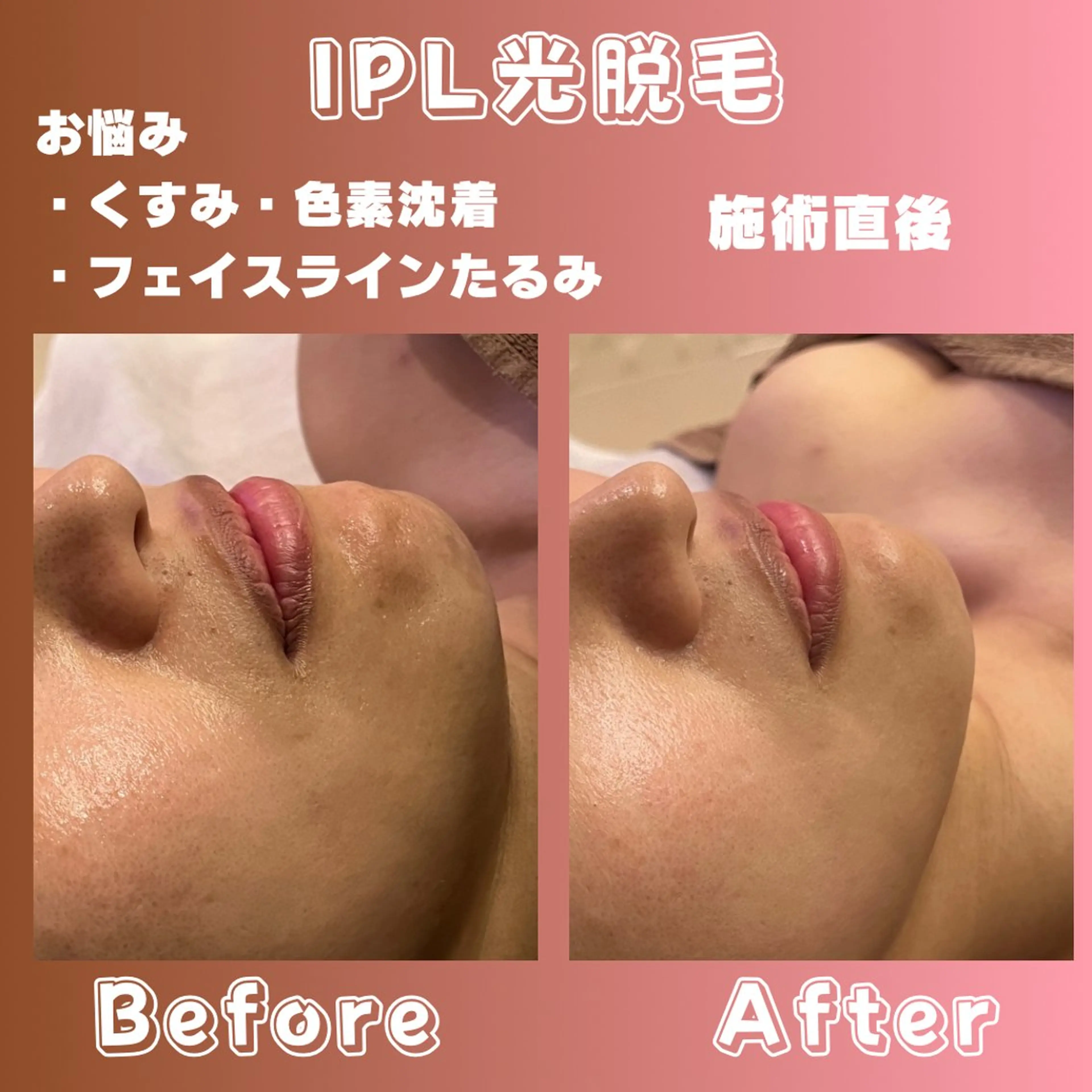 光フォト2種💡見た目で分かる‼︎くすみ&たるみケア組み合わせ♡全身脱毛/ミニモ限定価格女性メニュー🌷.*の写真