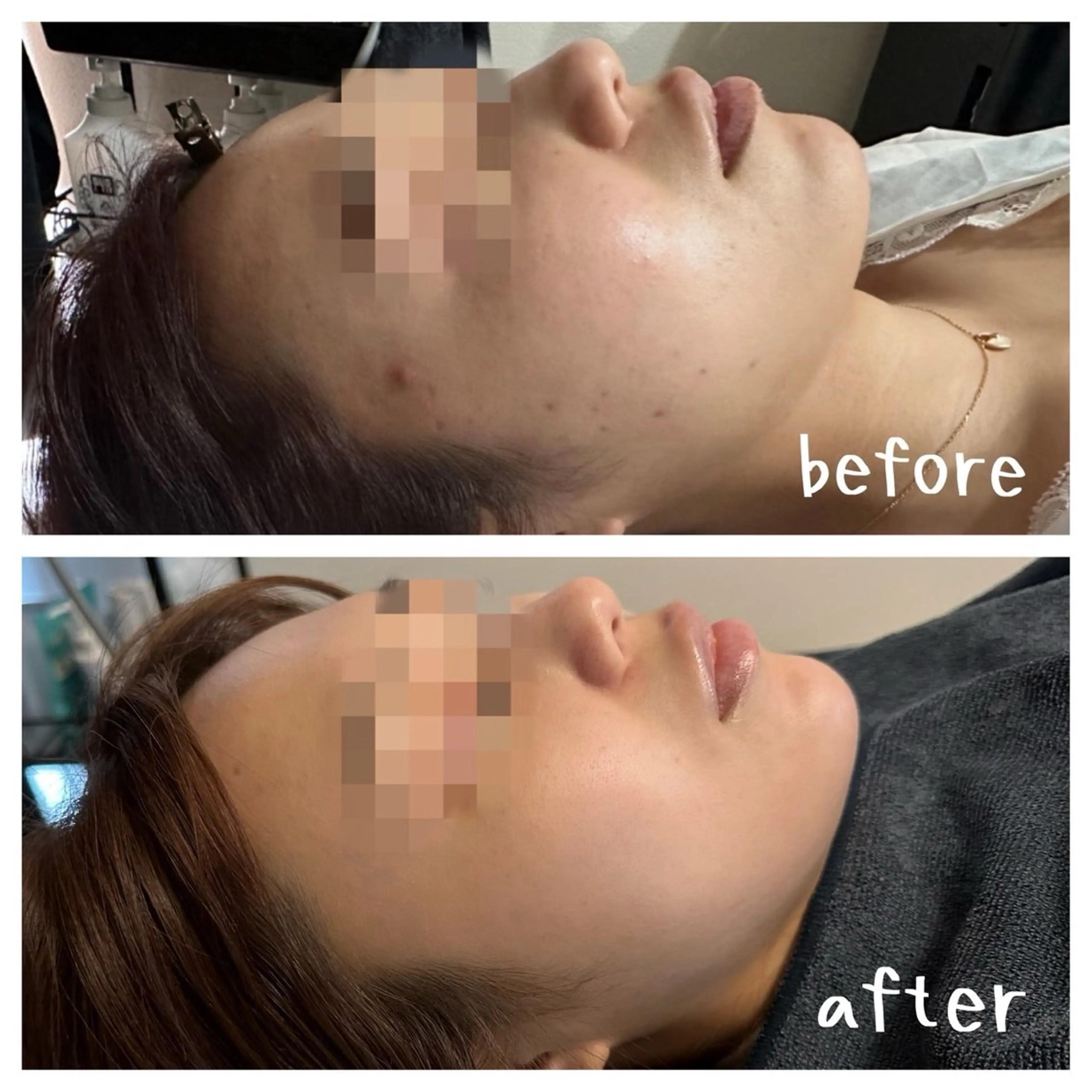 《再来1ヶ月以内》高浸透ハーブピーリング【毛穴/肌荒れ/ニキビ跡/テカリ/ハリ】の写真