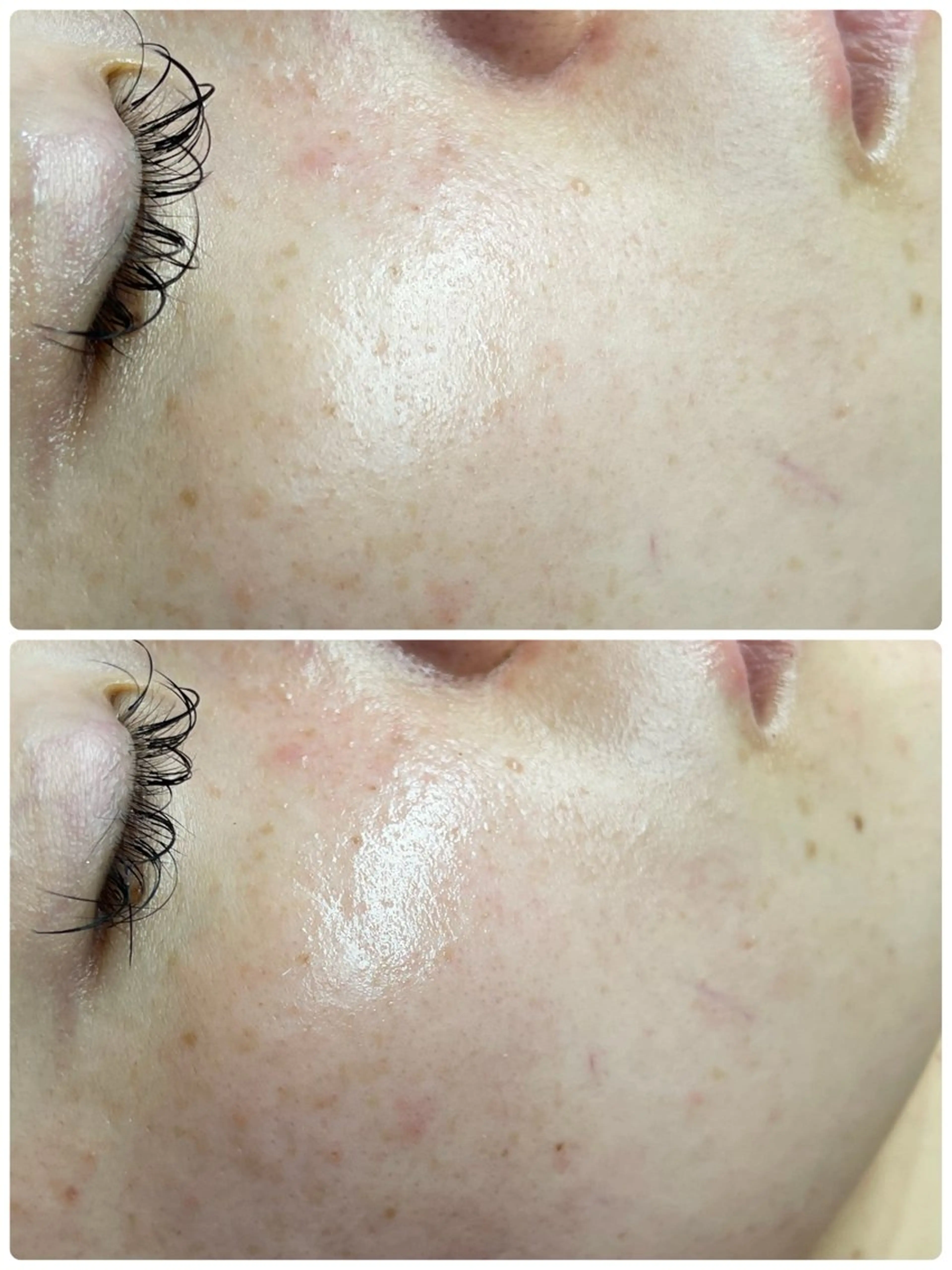 エステ REVI取扱・肌悩み 毛穴Chalonのエステ・リラクイメージ