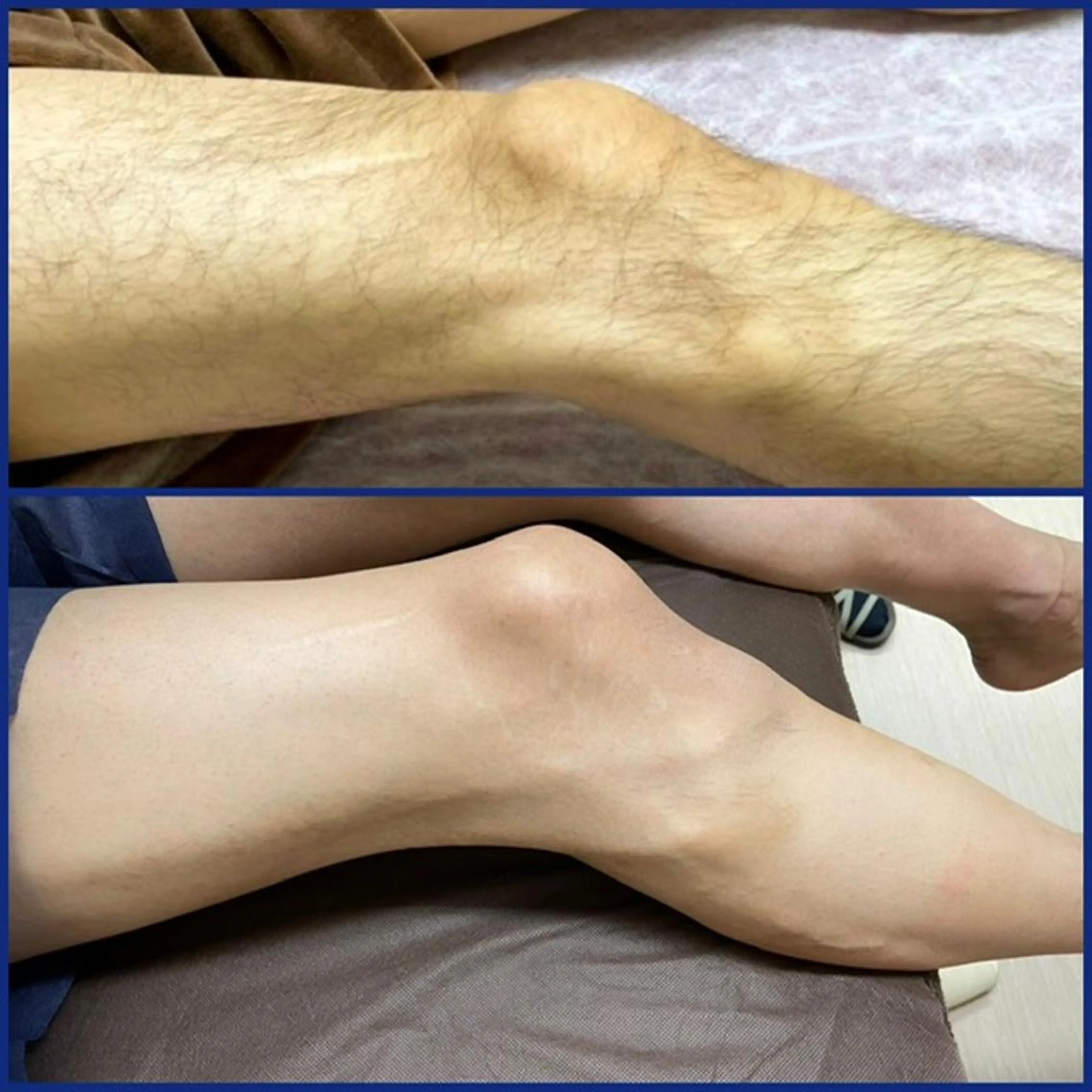 Tシャツ短パンの着こなしレベルを上げる！腕&脚脱毛　¥1,980の写真