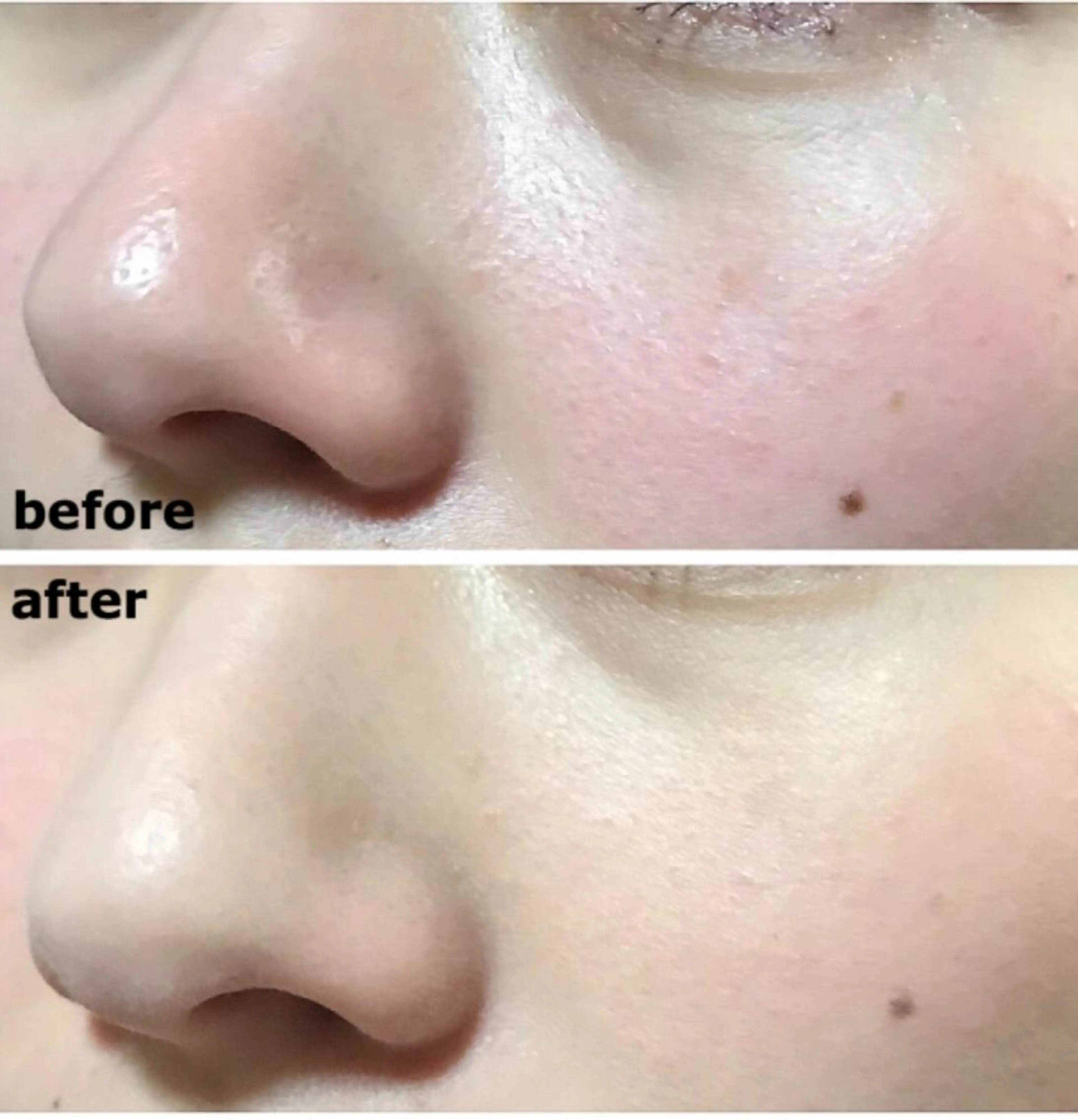 ミニモ限定❣️ミニモでご予約の方限定で超音波の毛穴洗浄をプレゼント🎁の写真