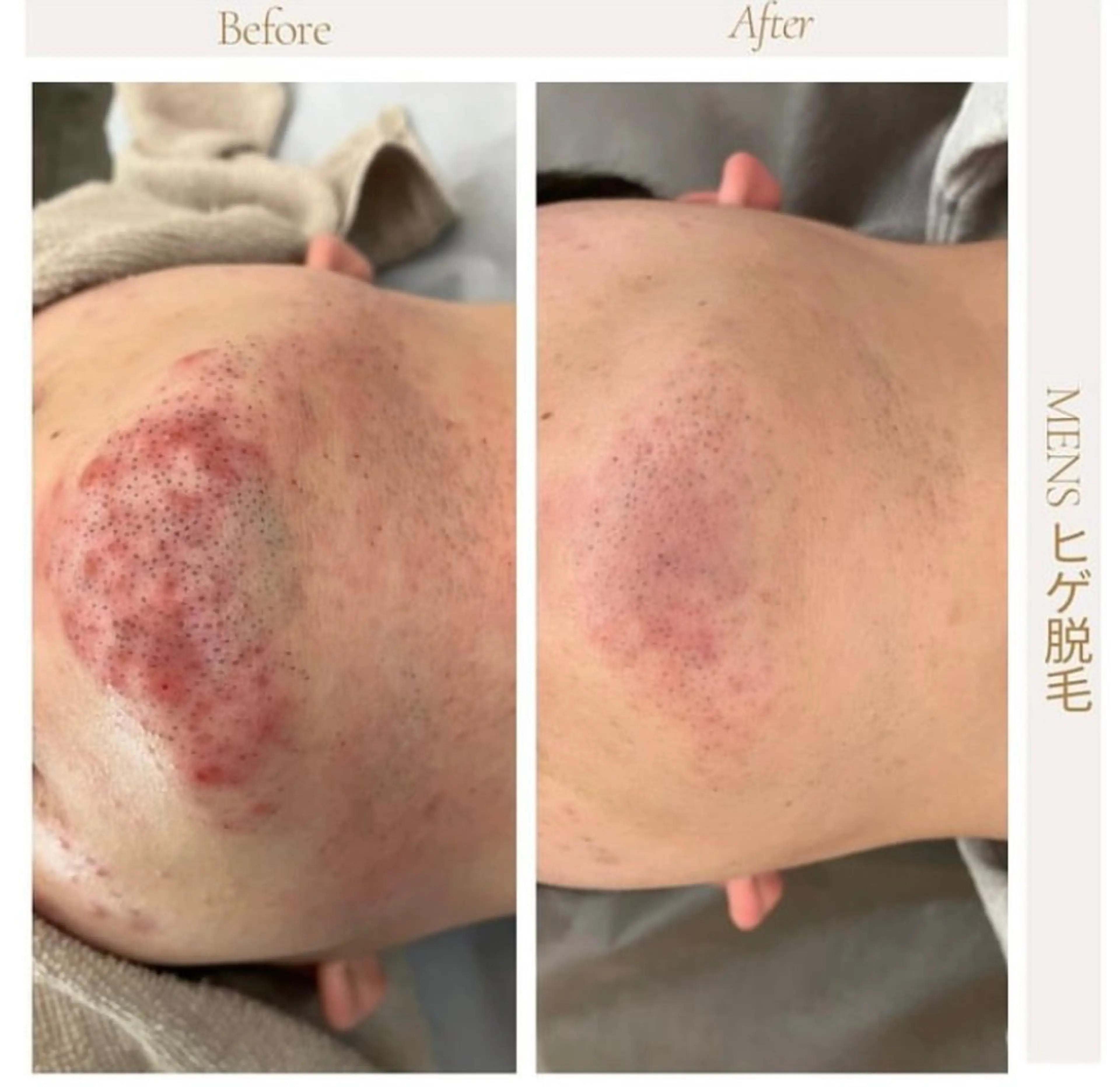 メンズ 脱毛&フェイシャル/ Rappore;増田のエステ・リラクイメージ