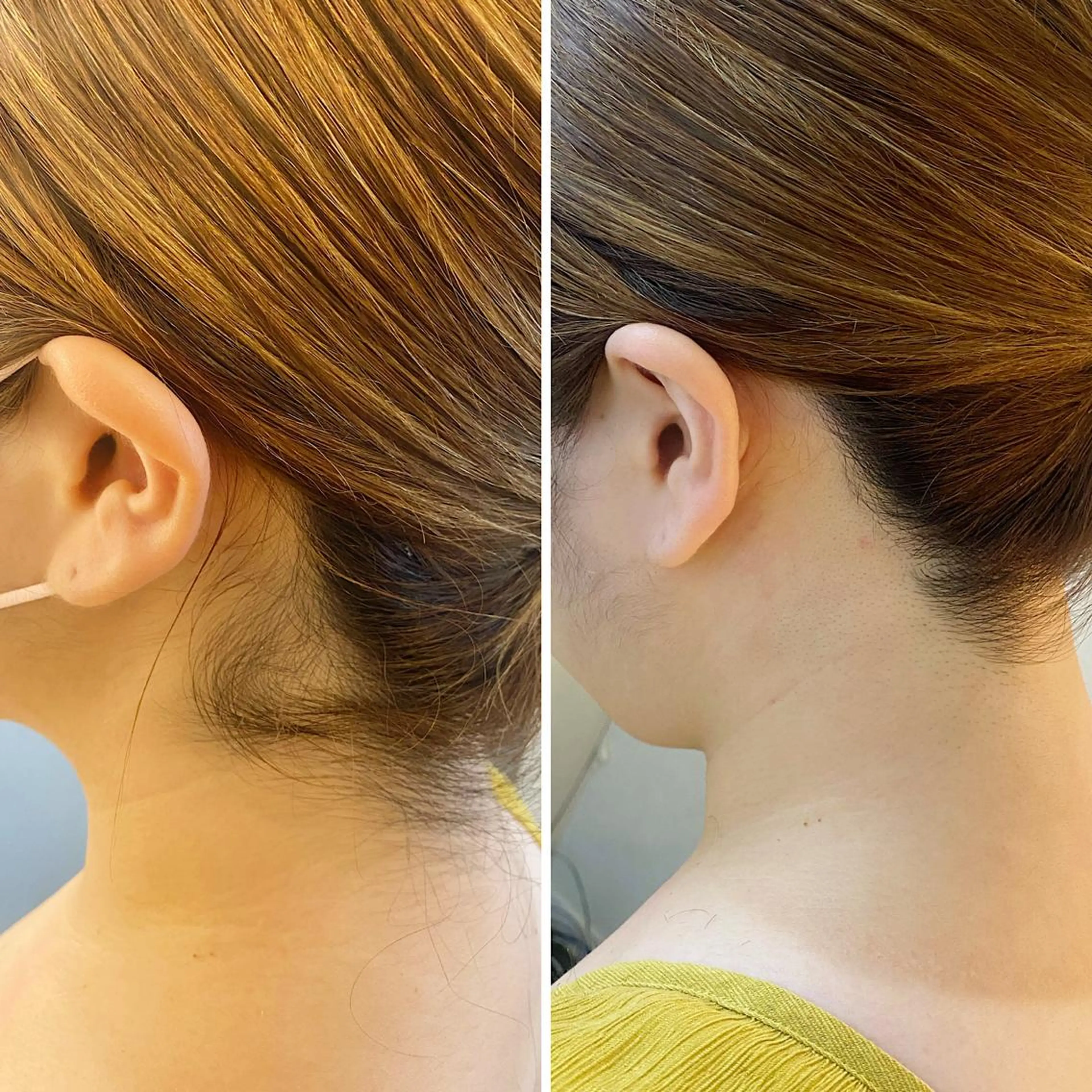 脱毛 うなじ脱毛/美肌脱毛 LABELのエステ・リラクイメージ