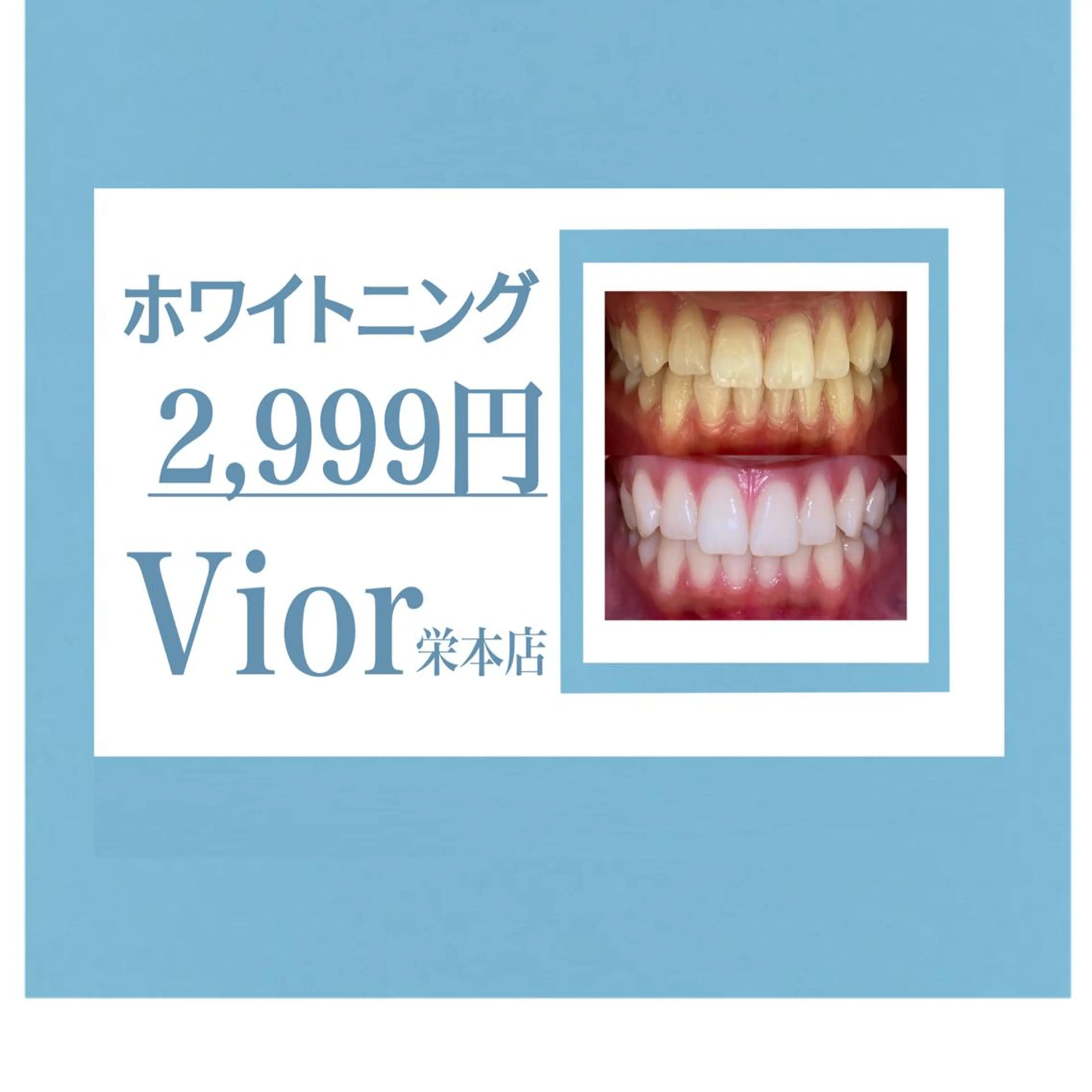 歯のセルフホワイトニング3回照射 (1回あたり999円)の写真