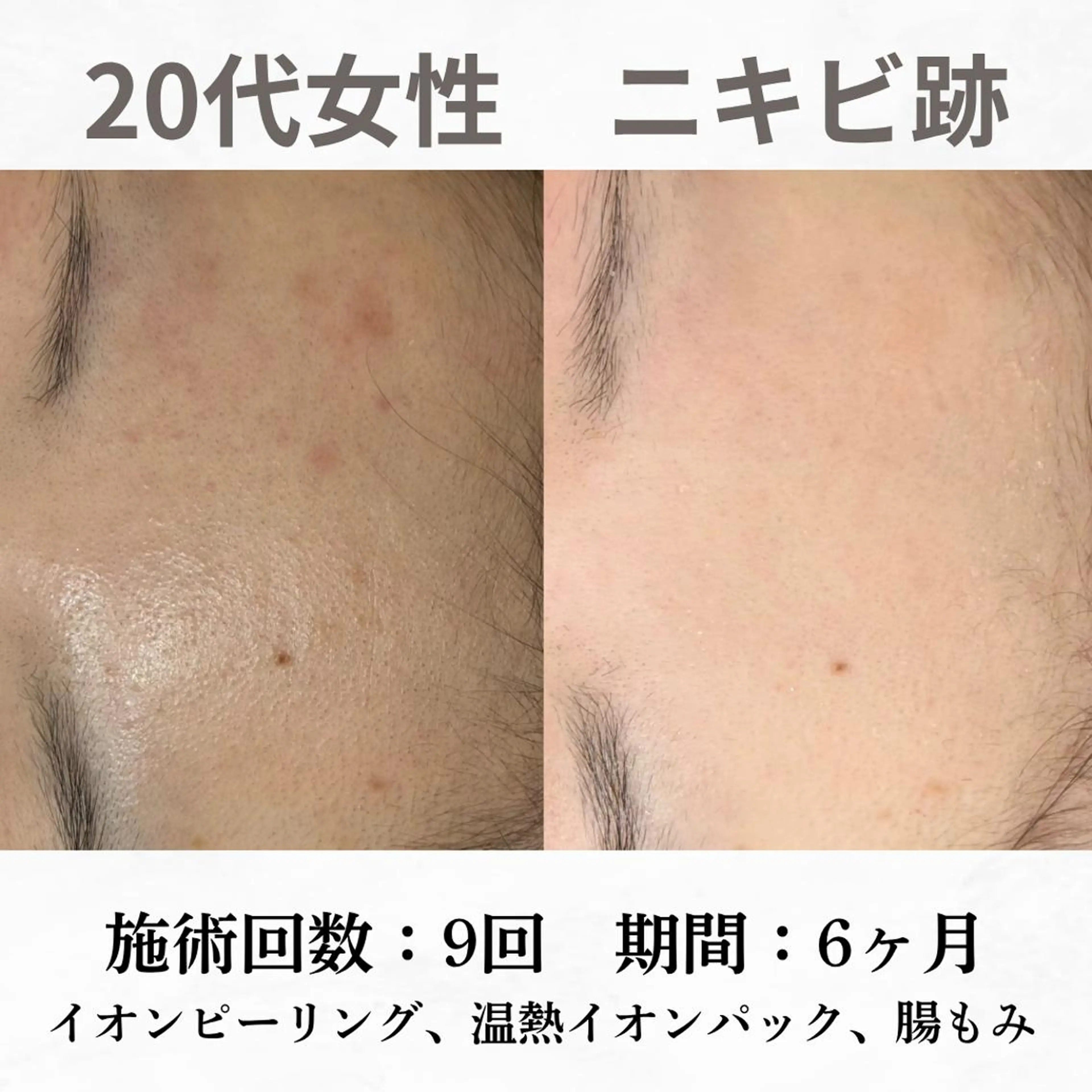 重度ニキビ専門🌷 ダウンタイムなしのエステ・リラクイメージ