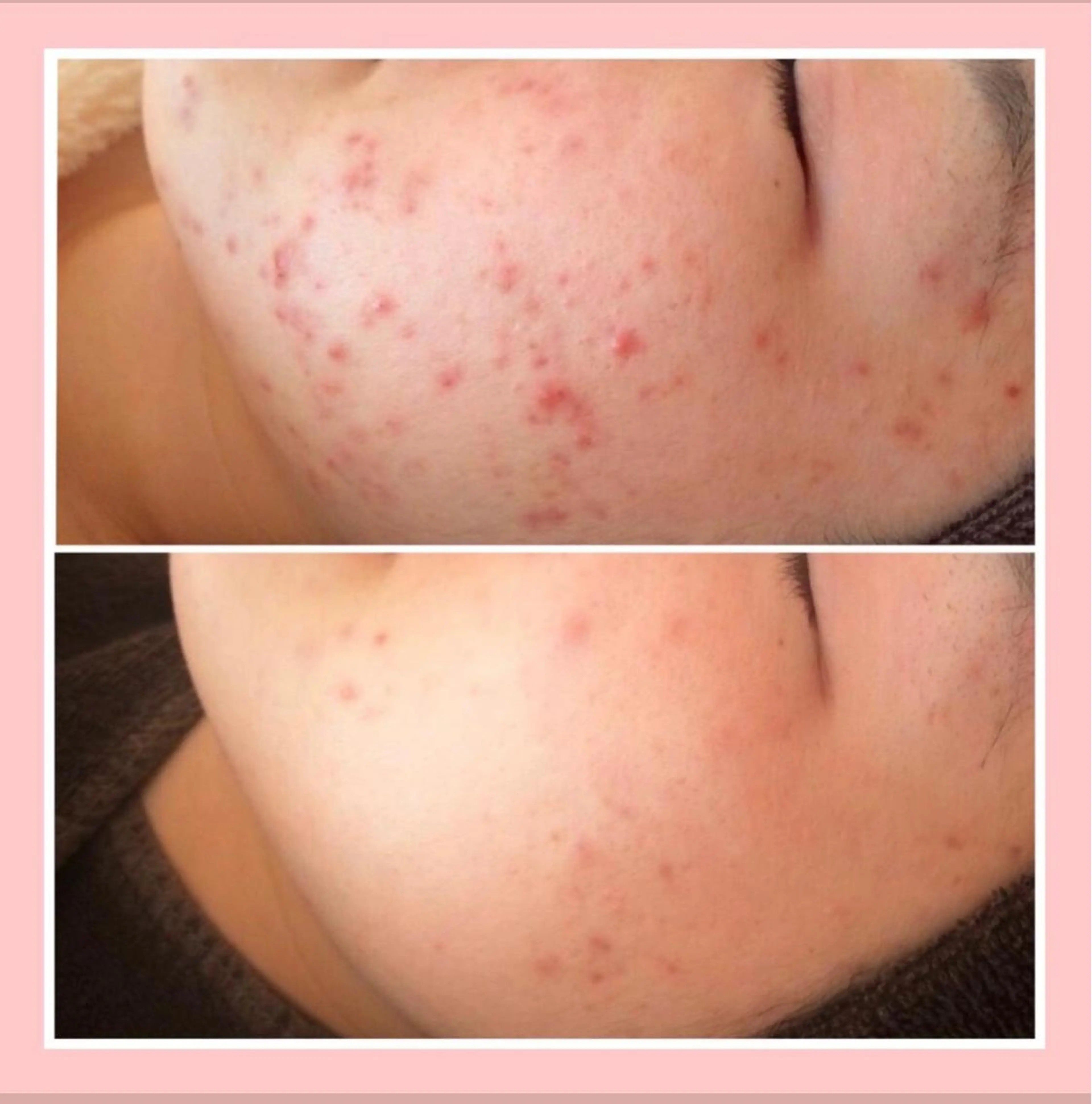 セミロング カラー パーマ ヘアアレンジ メンズ キッズ ネイル マツエク・マツパ アイブロウ 3か月で肌革命👼 ニキビ専門店💫のエステ・リラクイメージ