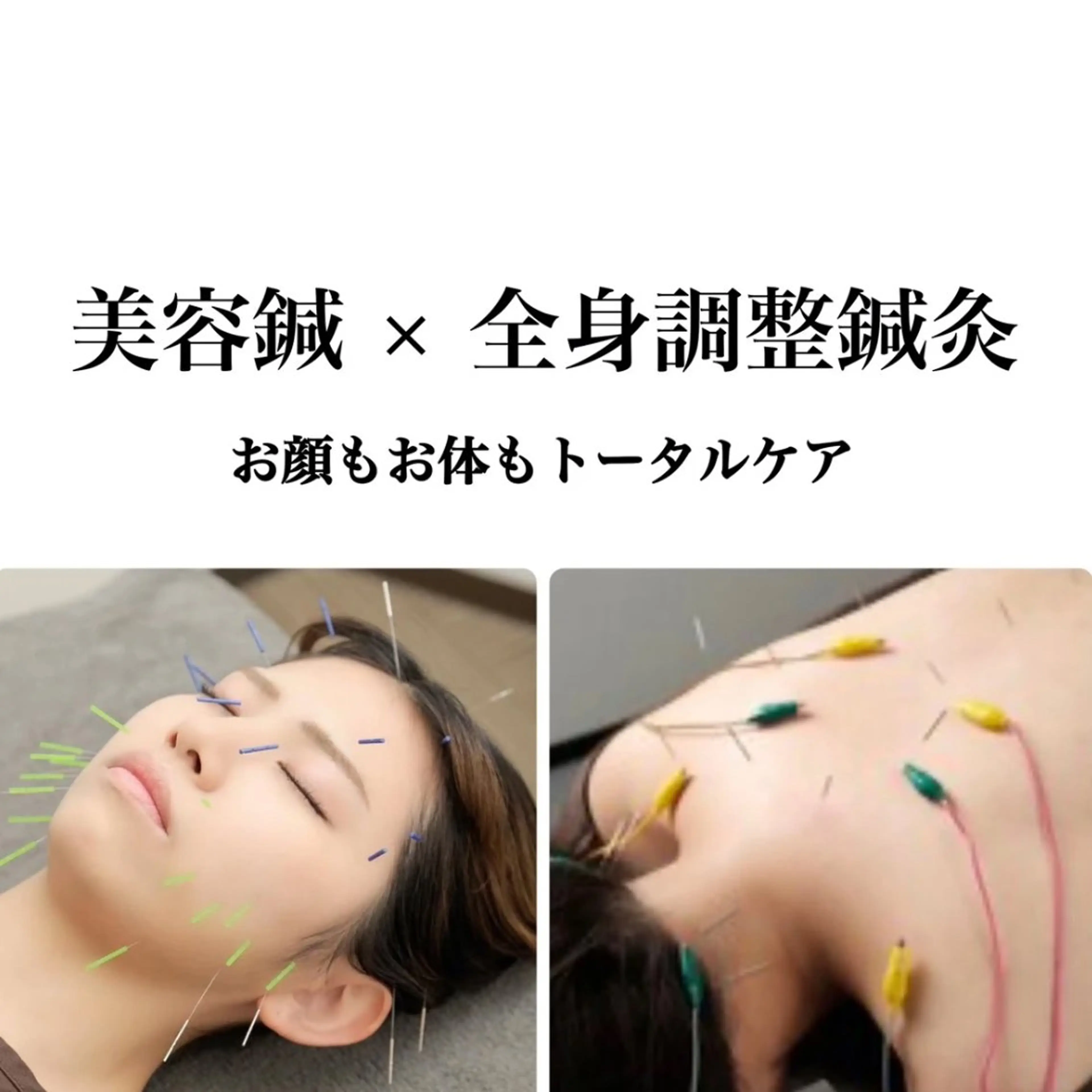【美容鍼+全身鍼灸+小顔矯正🪡❤️90分】初回のみ別途カウンセリング30分/お時間の余裕を持ってご来店ください☺️の写真