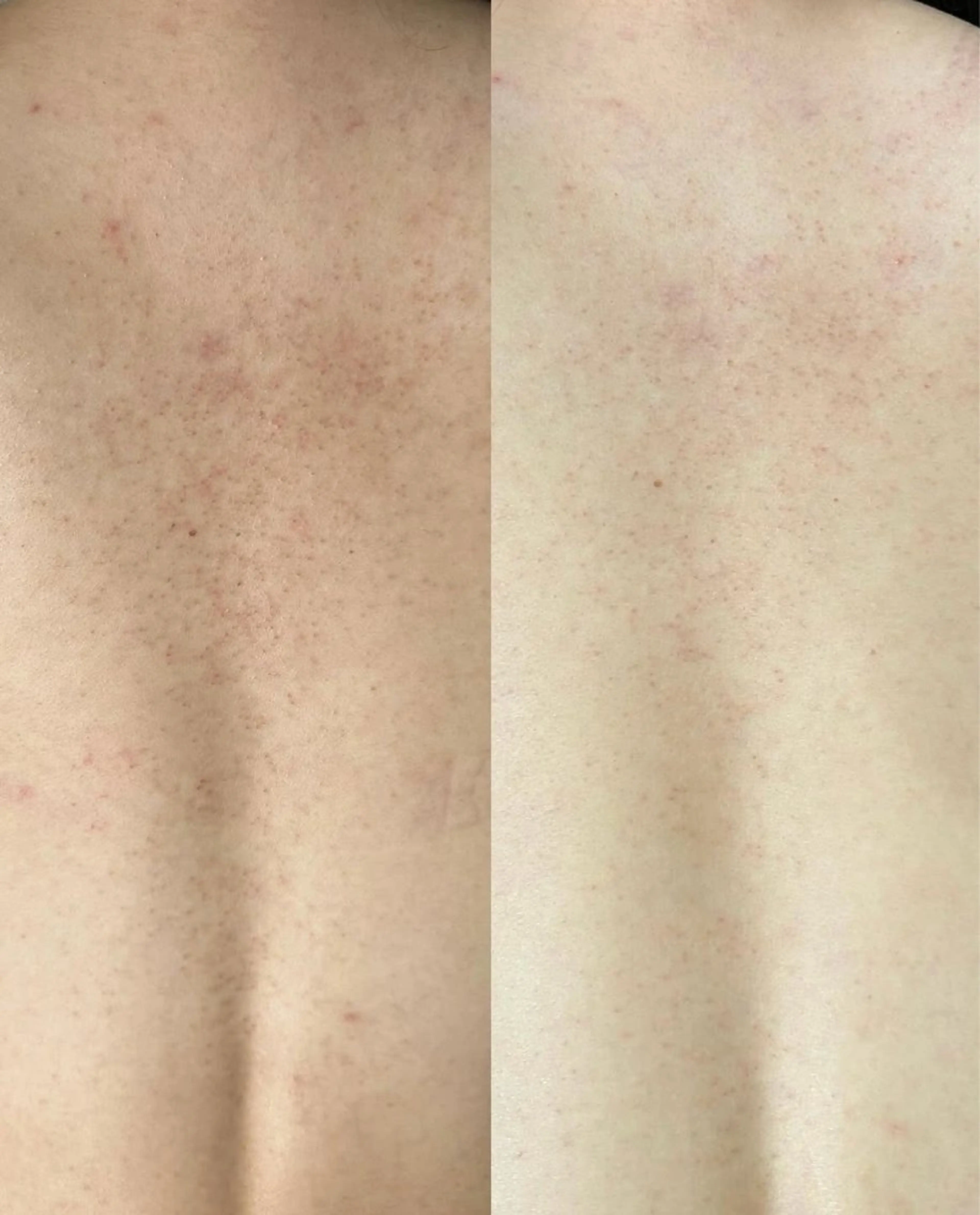 ニキビ・ニキビ跡🌿 ハーブピーリング✨のその他イメージ