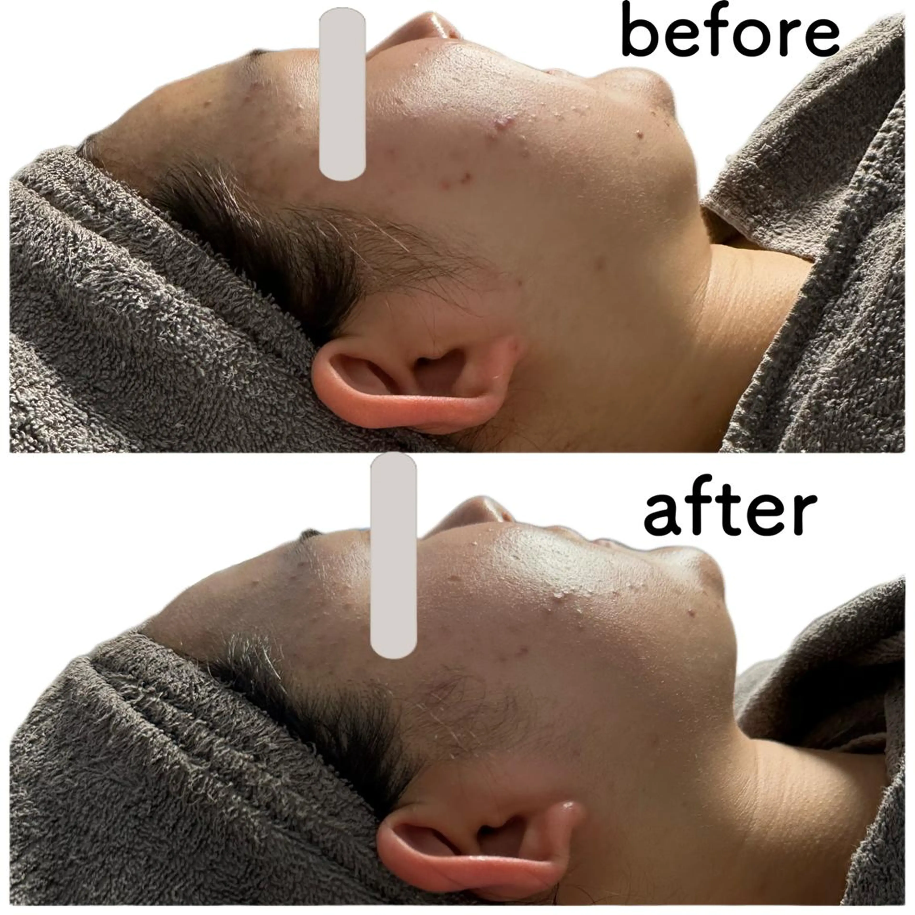 痩身ハイパーナイフ ララピールリアボーテのエステ・リラクイメージ