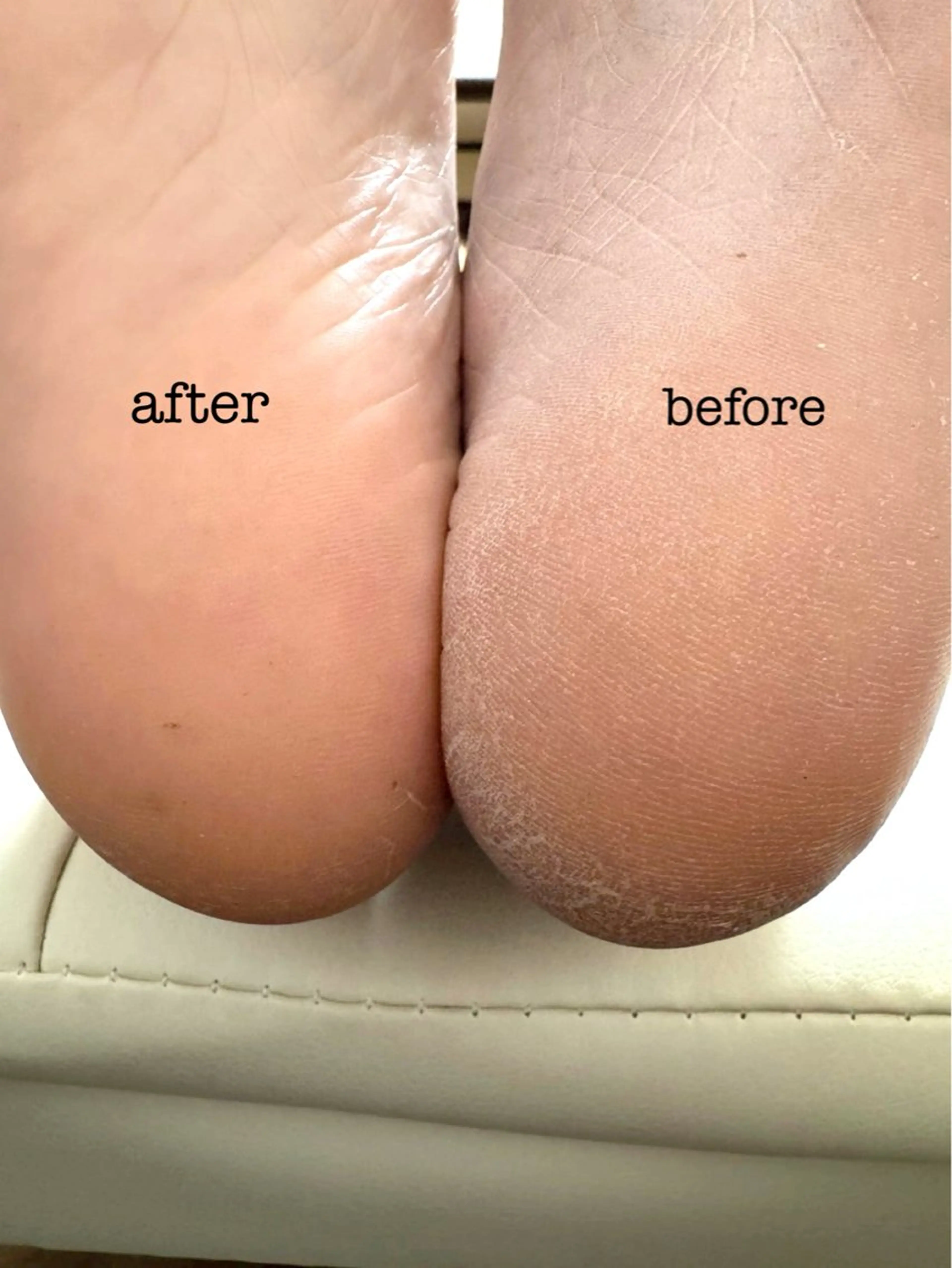 フット角質ケア（スクラブ、フットバス無し）の写真