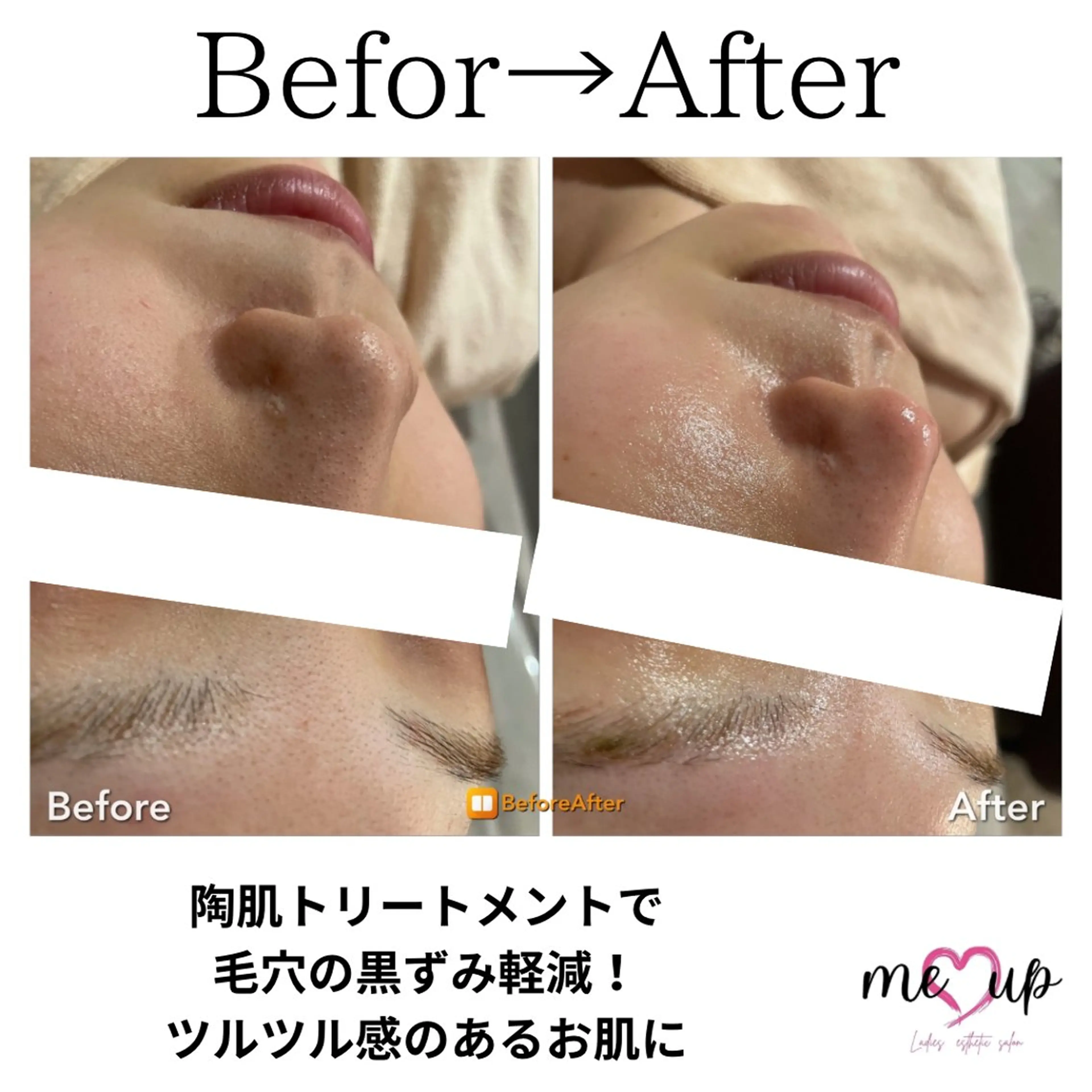 エステ Meupニキビ専門店 背中/ハーブ/肌管理のその他イメージ