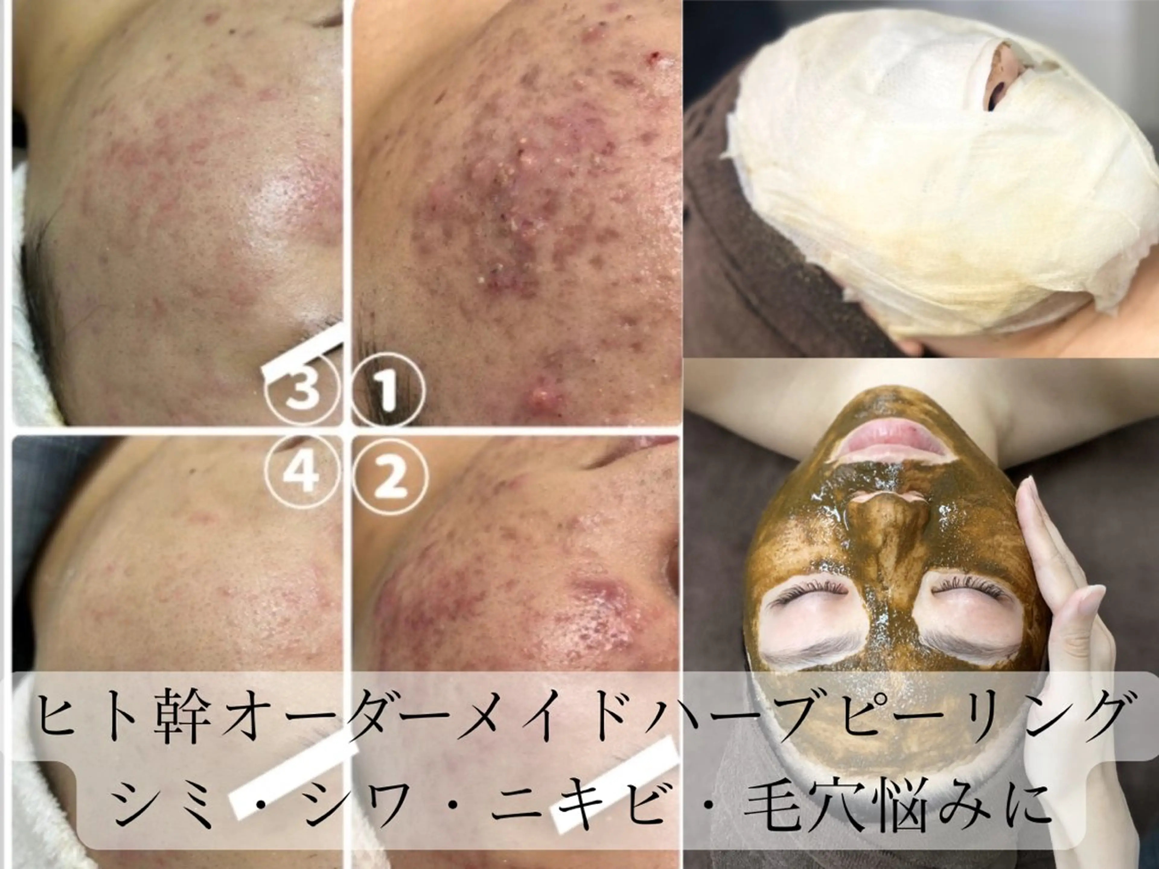 【ニキビ・毛穴特化◎】ハーブピーリング【剥離なし】天然100%国産ハーブ×ヒト幹細胞配合の写真