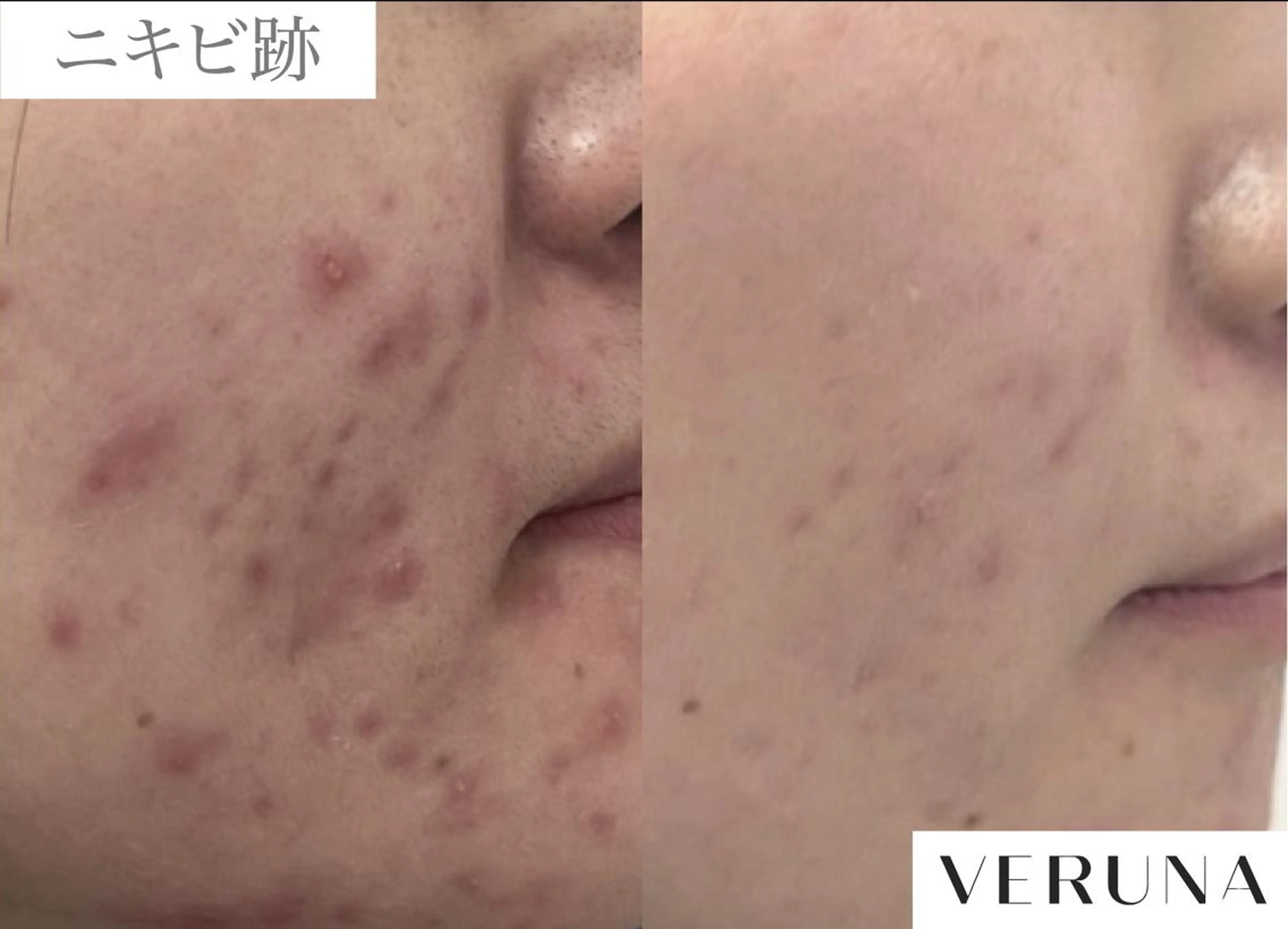 ハーブピーリング剥離あり〈オーダーメイド調合施術〉の写真