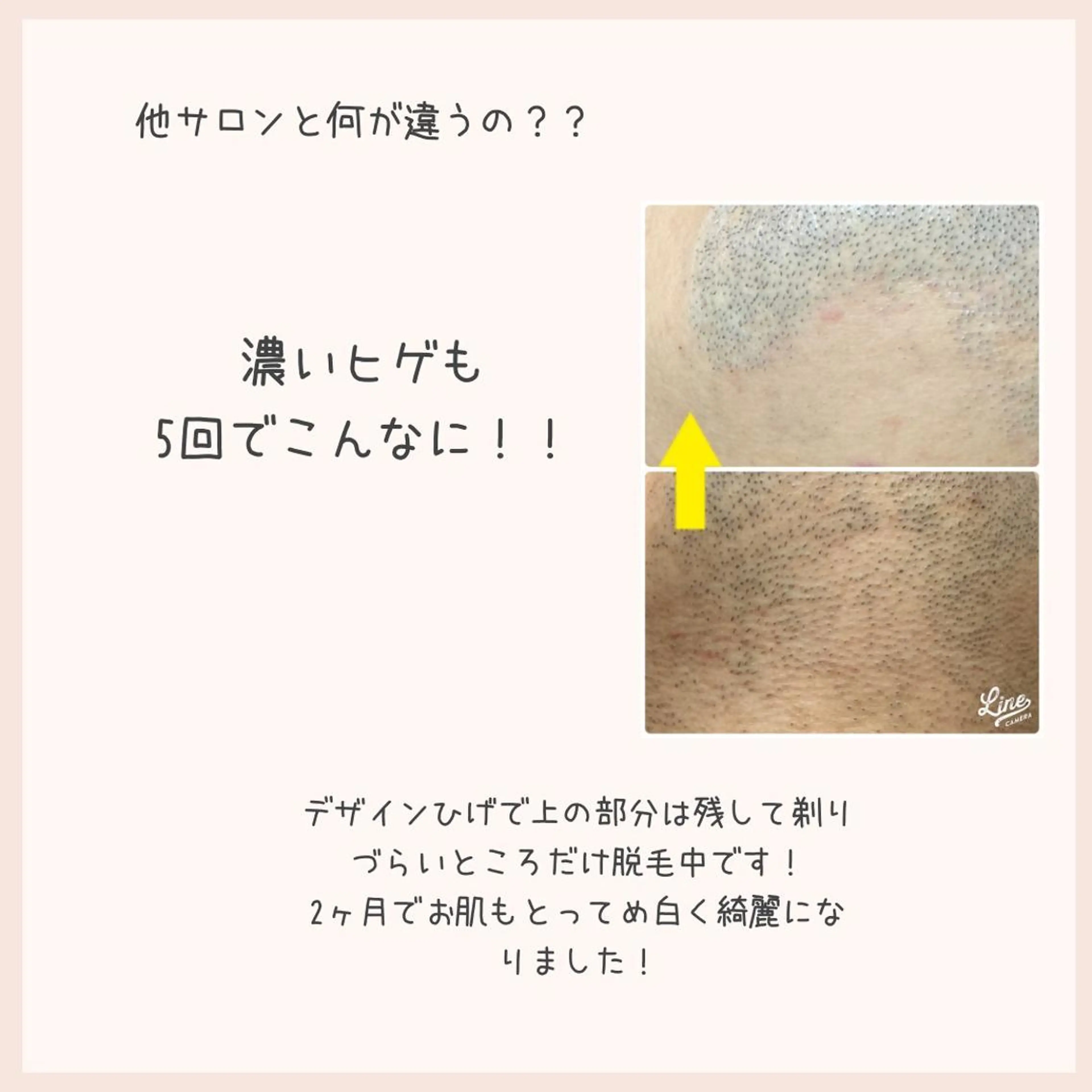【メンズ限定メニュー】髭が白髪になる前に綺麗さっぱり髭剃りからさようなら👋の写真