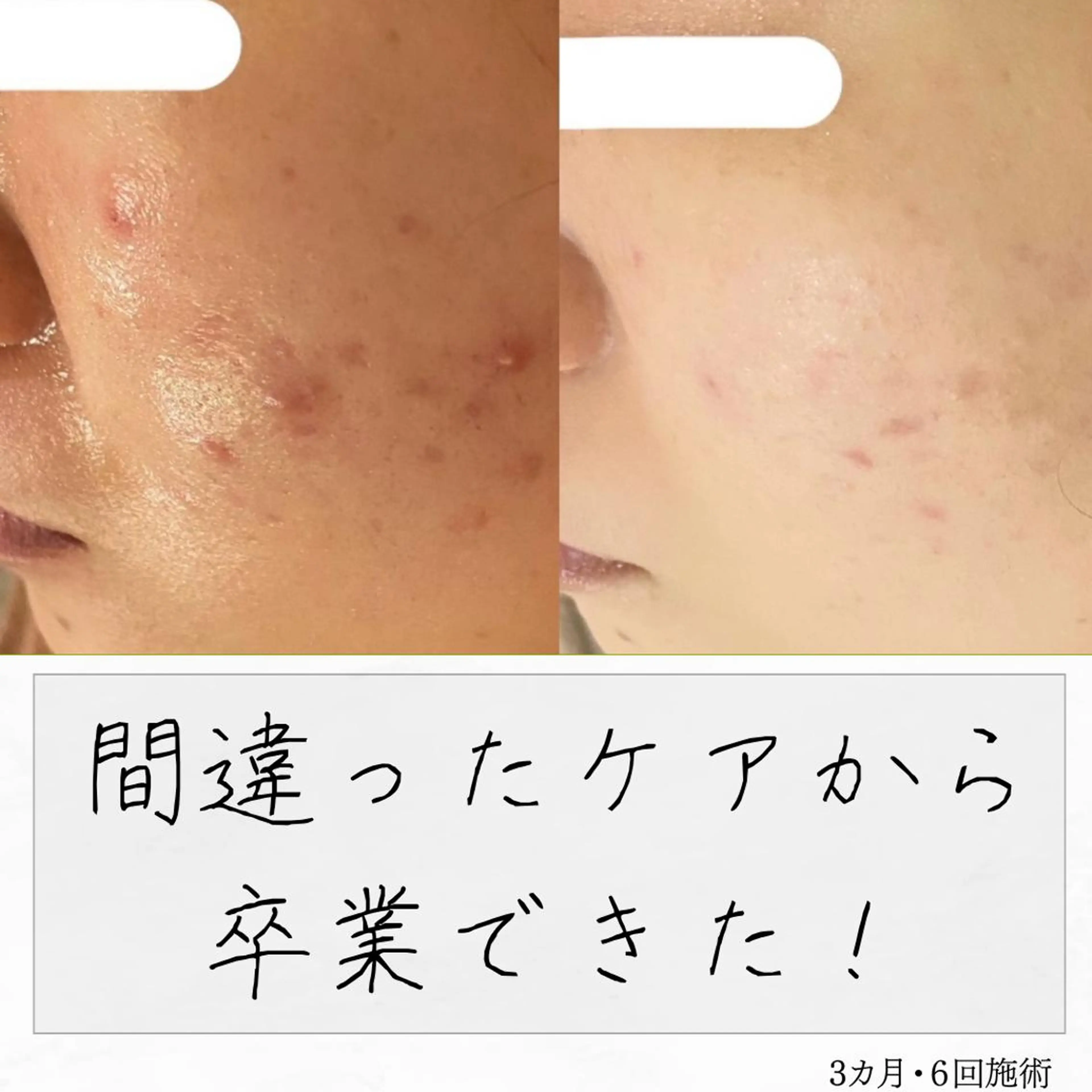 ニキビ経験者が施術 する専門サロン🌻のエステ・リラクイメージ