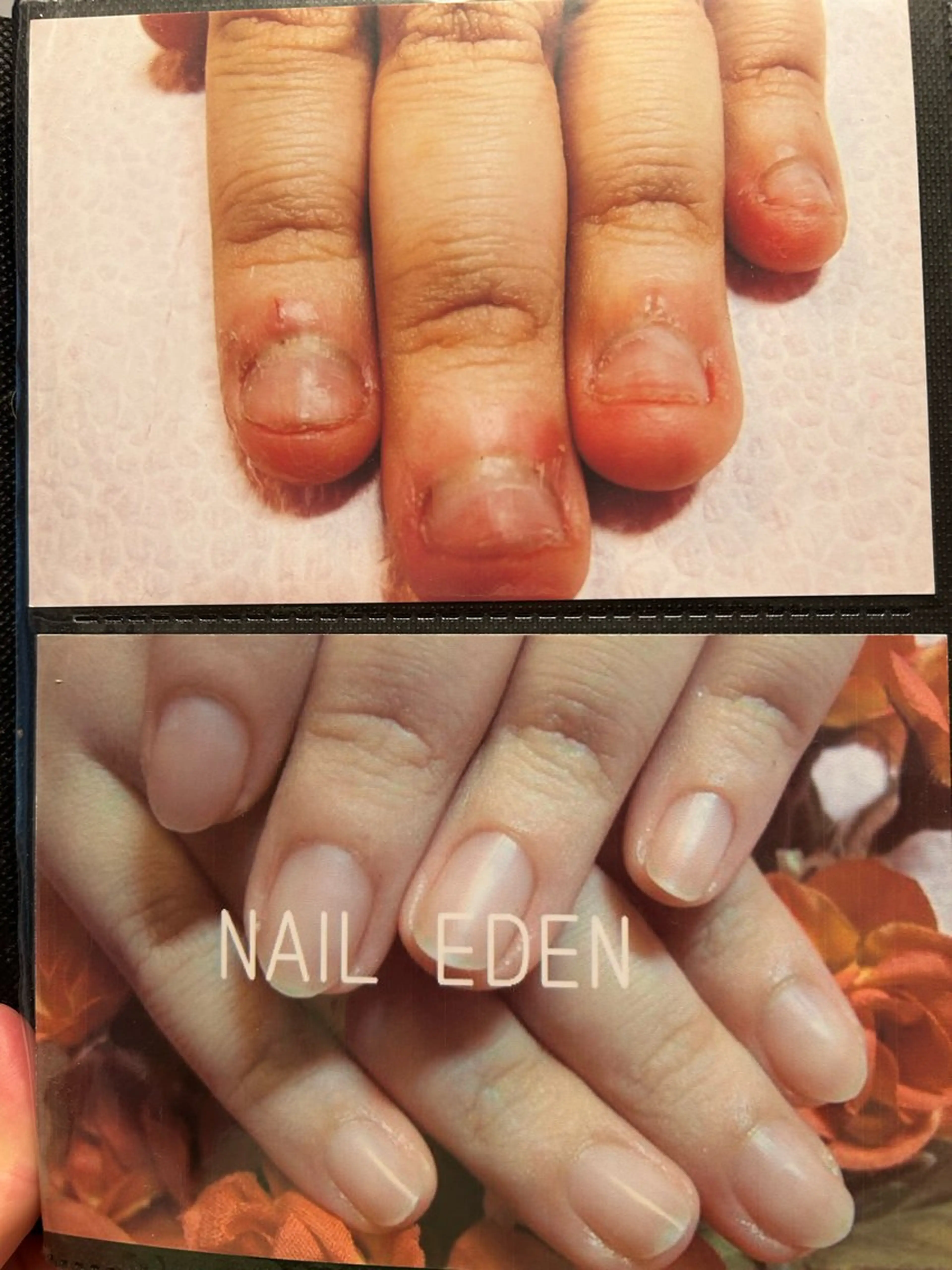 エデン式深爪ケアの初回スカルプチュアの装着。初回16000円→12000円の写真