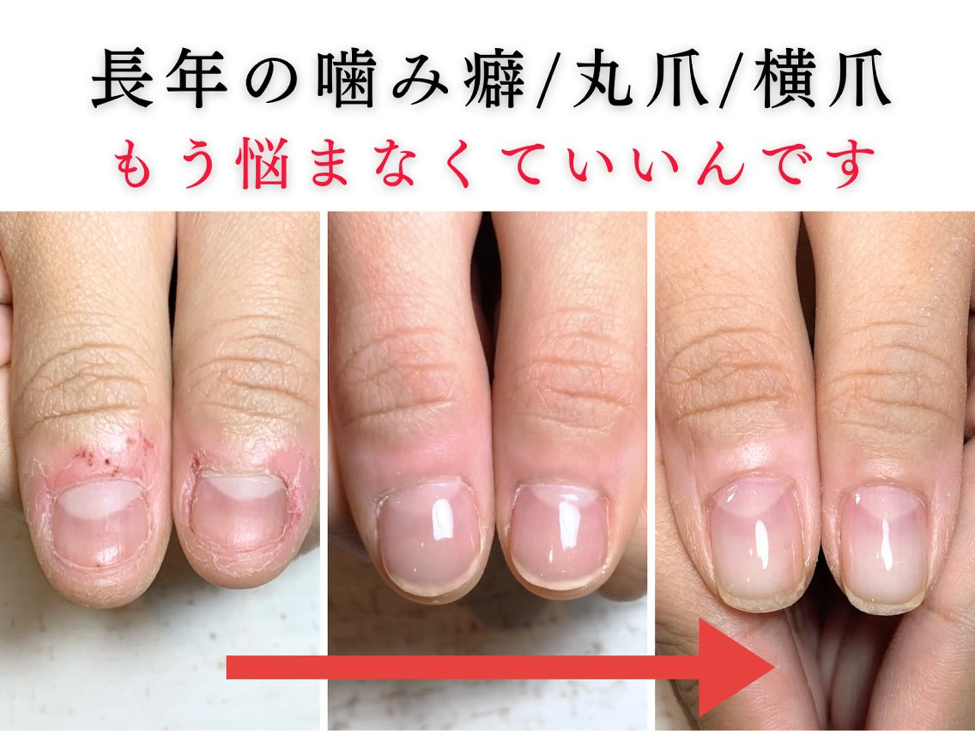 ネイル 深爪矯正・自爪育成 ネイルサロンアモここのネイルデザイン