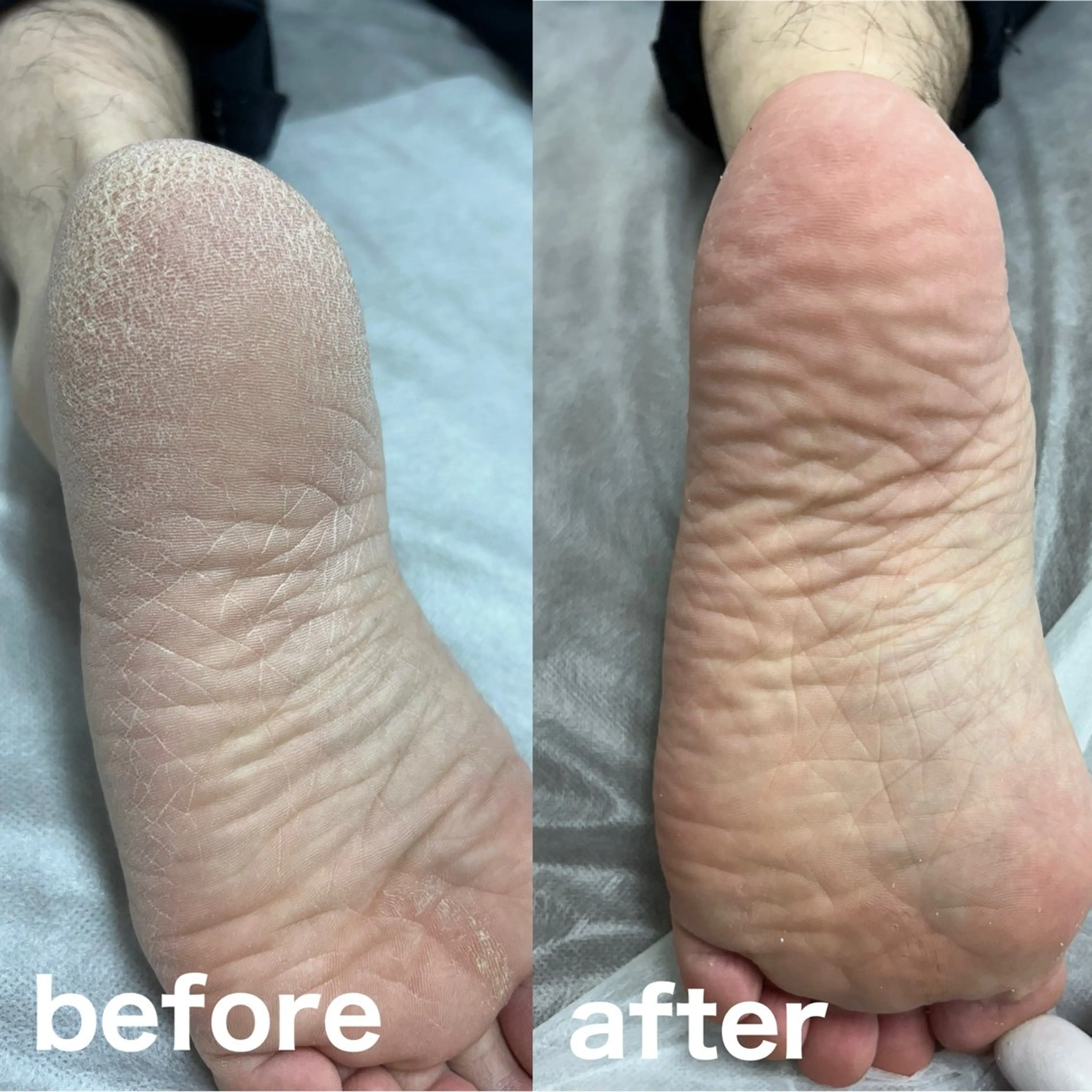 フット角質ケアの写真