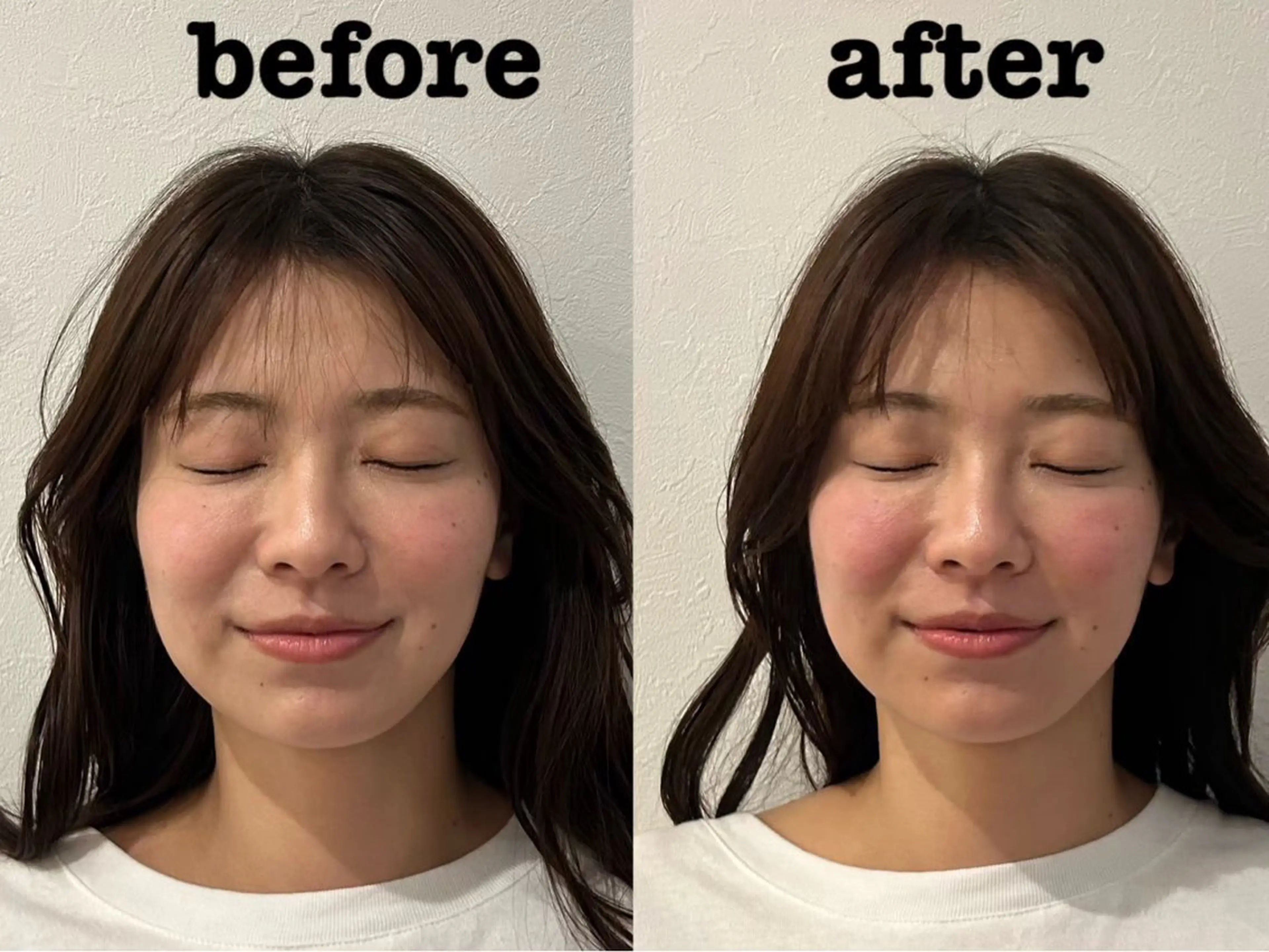 エステ リラク 美容鍼灸Solana所属・肌質改善×美容鍼 ゆいのエステ・リラクイメージ