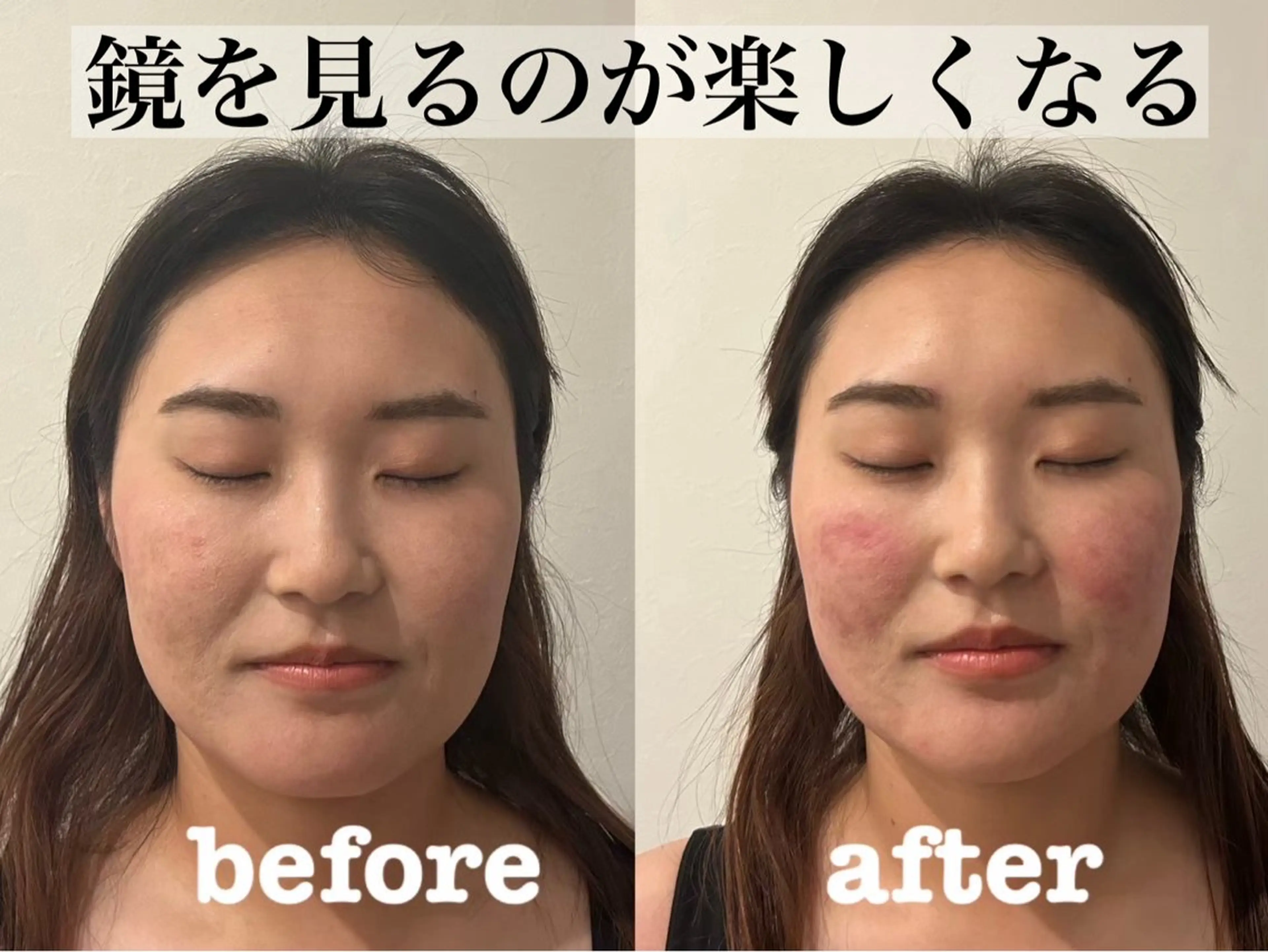 エステ リラク 肌質改善×美容鍼 ゆいのエステ・リラクイメージ