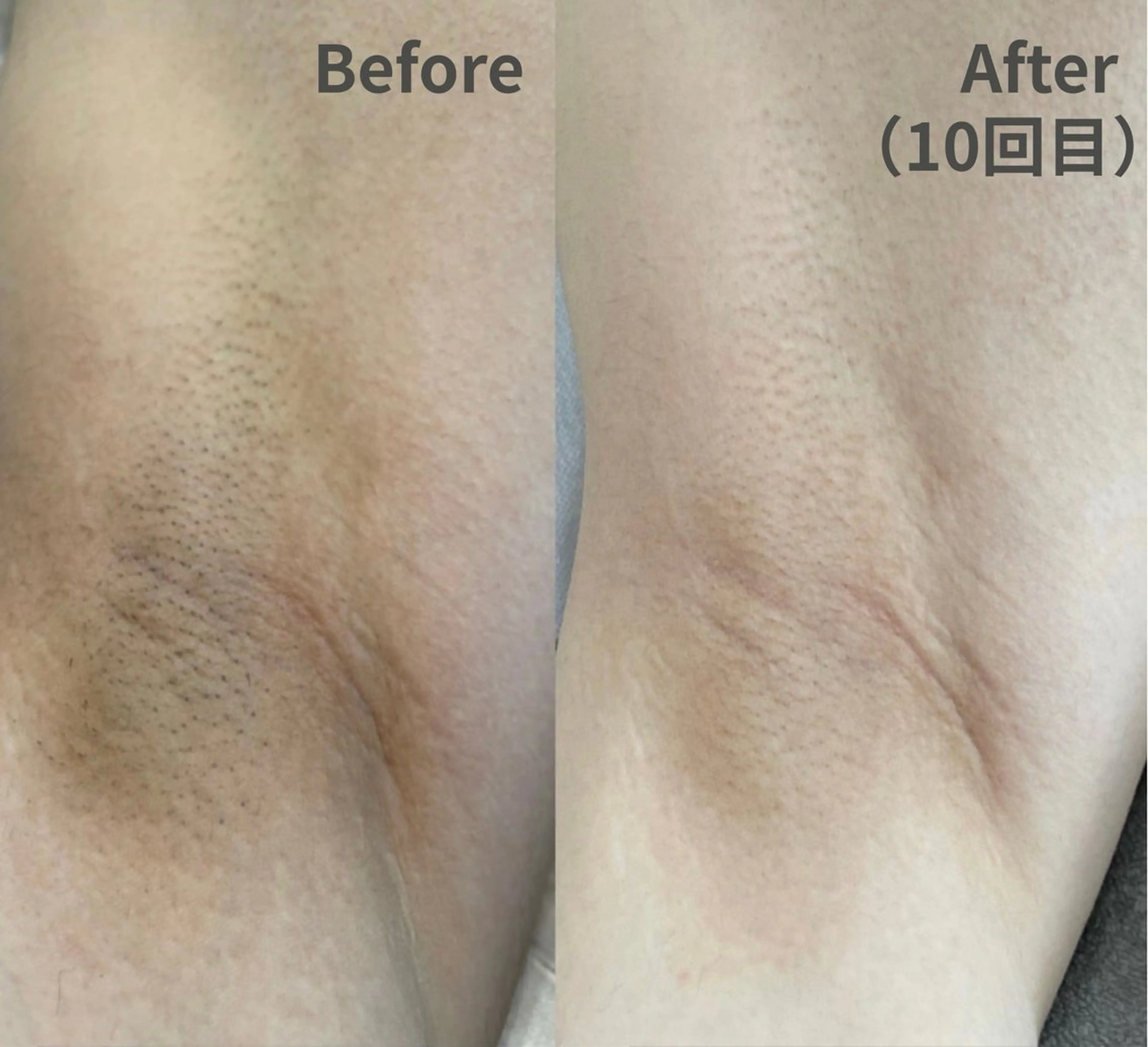 【夏の露出前に】効果重視！脇＋両腕つるすべ脱毛 ￥3,300の写真