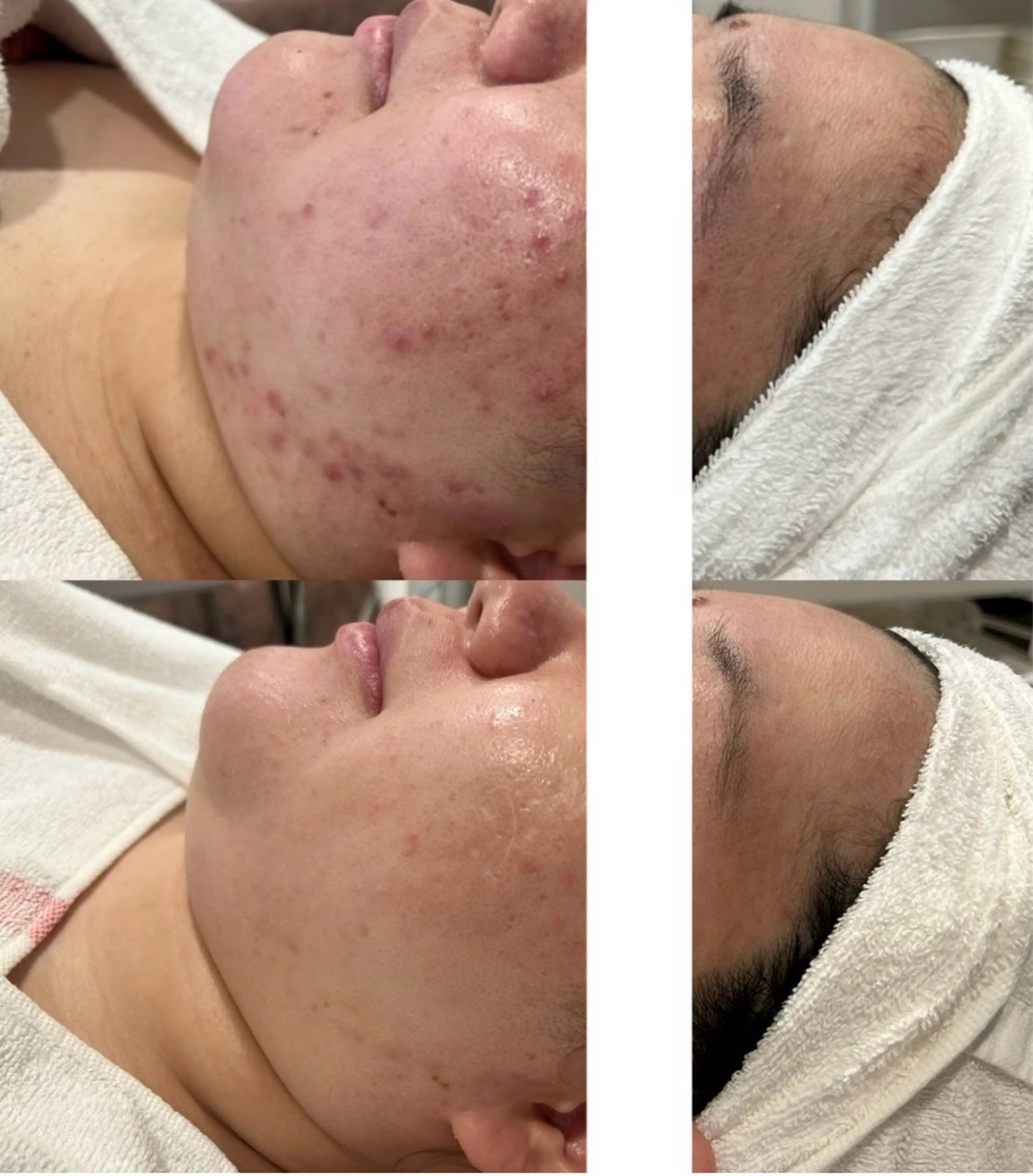 【長年お悩みの方お任せ下さい✨】肌悩み別フェイシャルエステ⭐︎生コラーゲン入りでふっくら🫧60minの写真