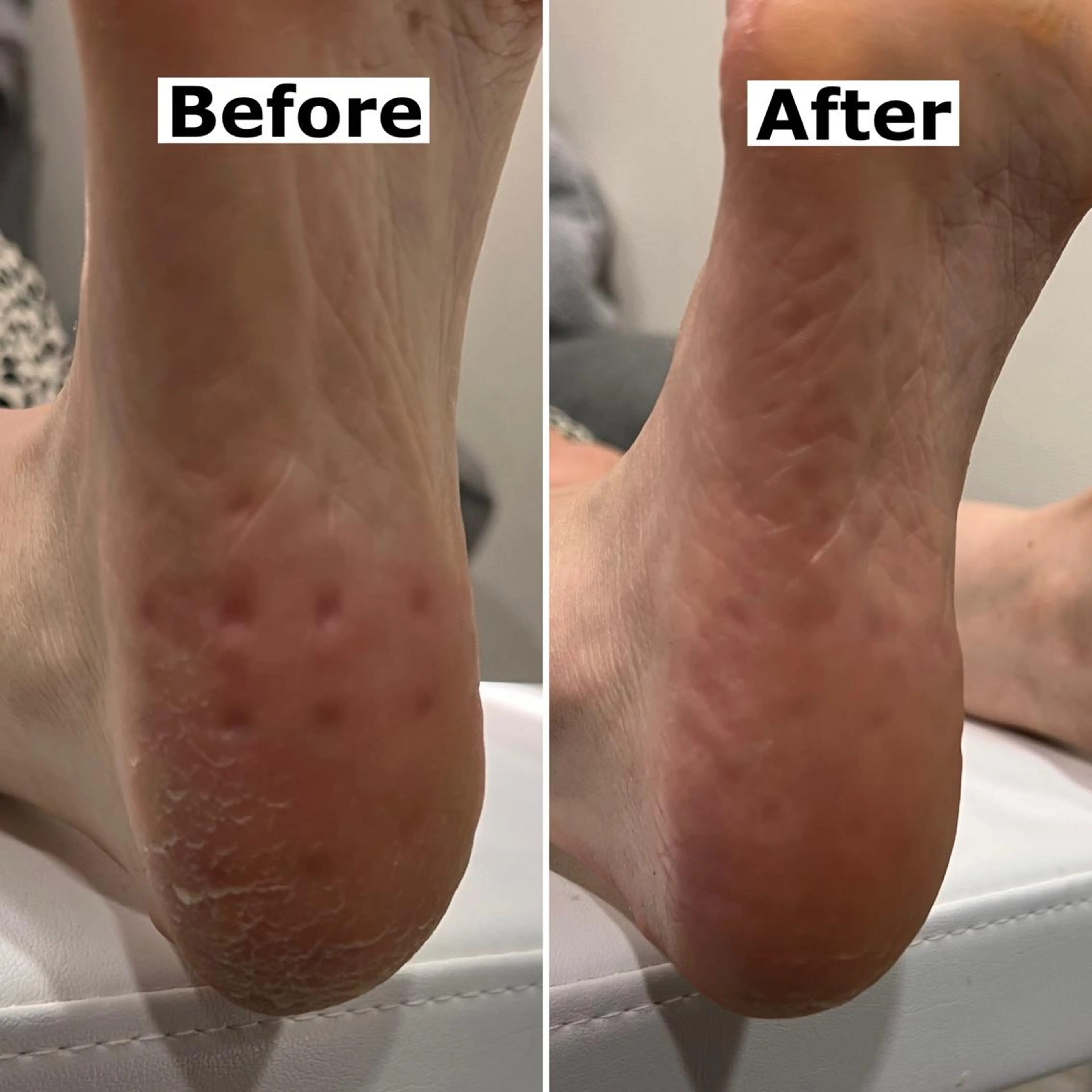 ネイル Mellow nail所属・巻爪無料モデル募集 ✨🦶MEGUMIのネイルデザイン