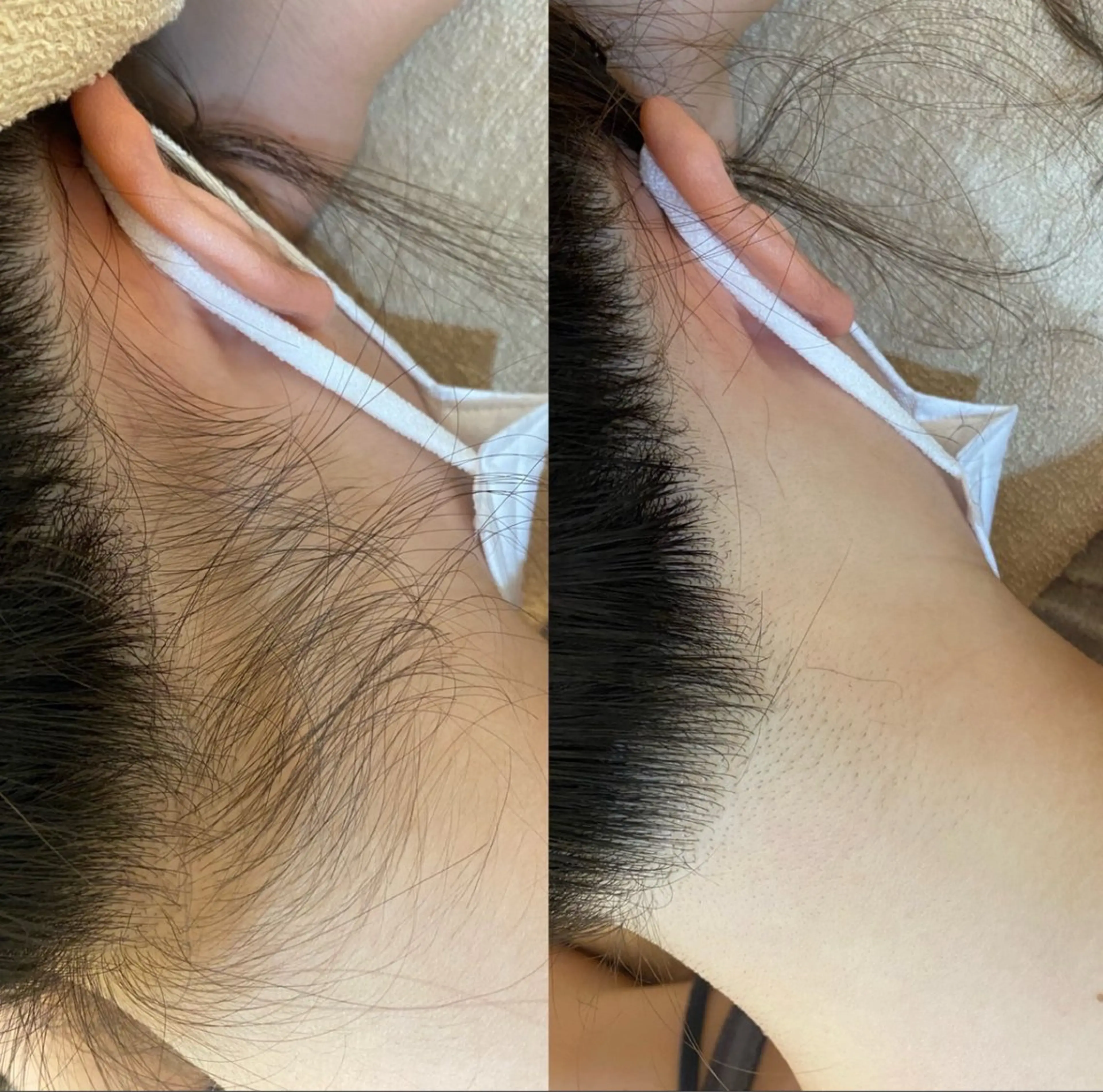 【女性】うなじ脱毛 🤍の写真