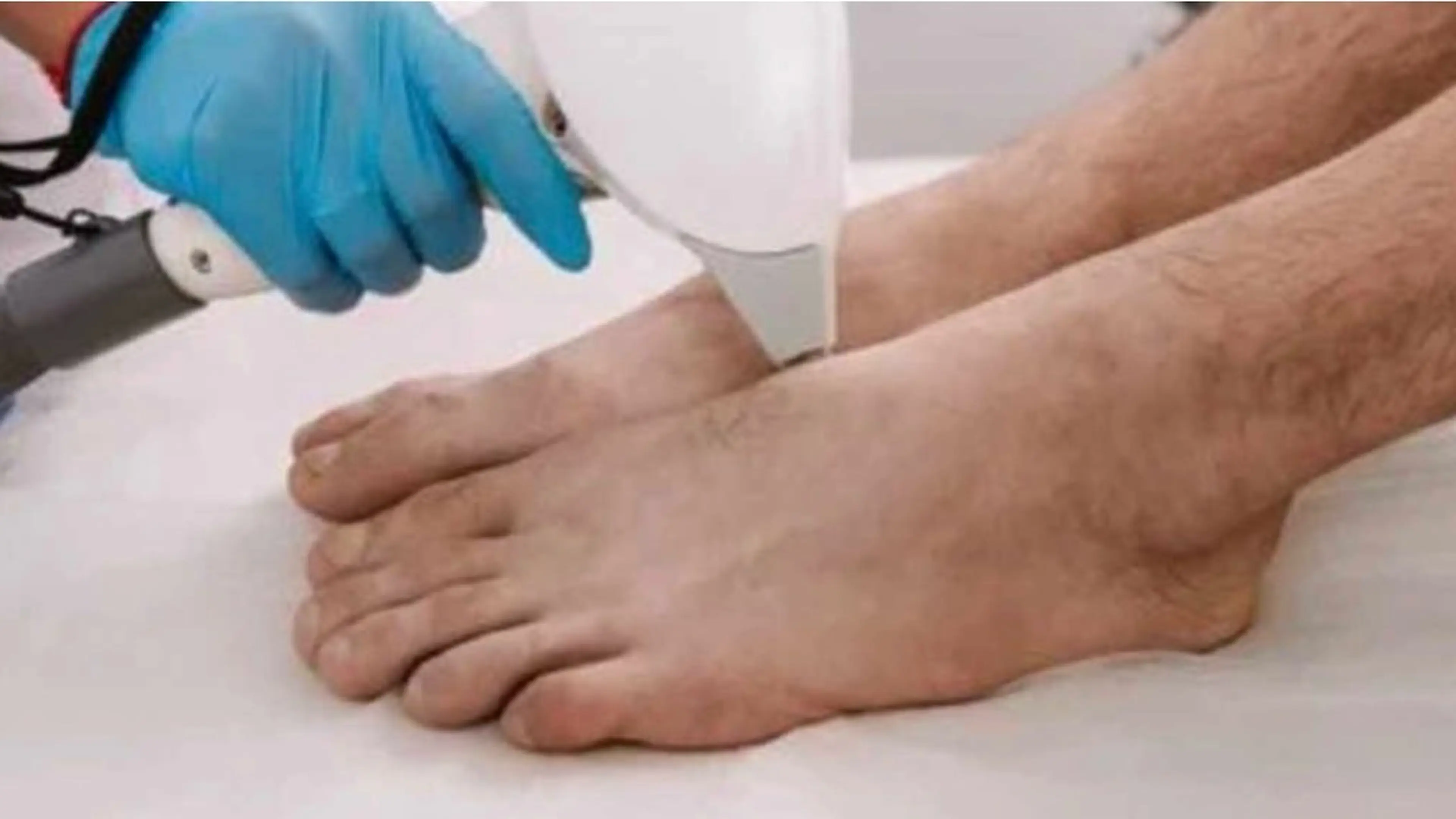 メンズ　Ｓパーツ脱毛（ワキor手の指と甲or足の指と甲）の写真