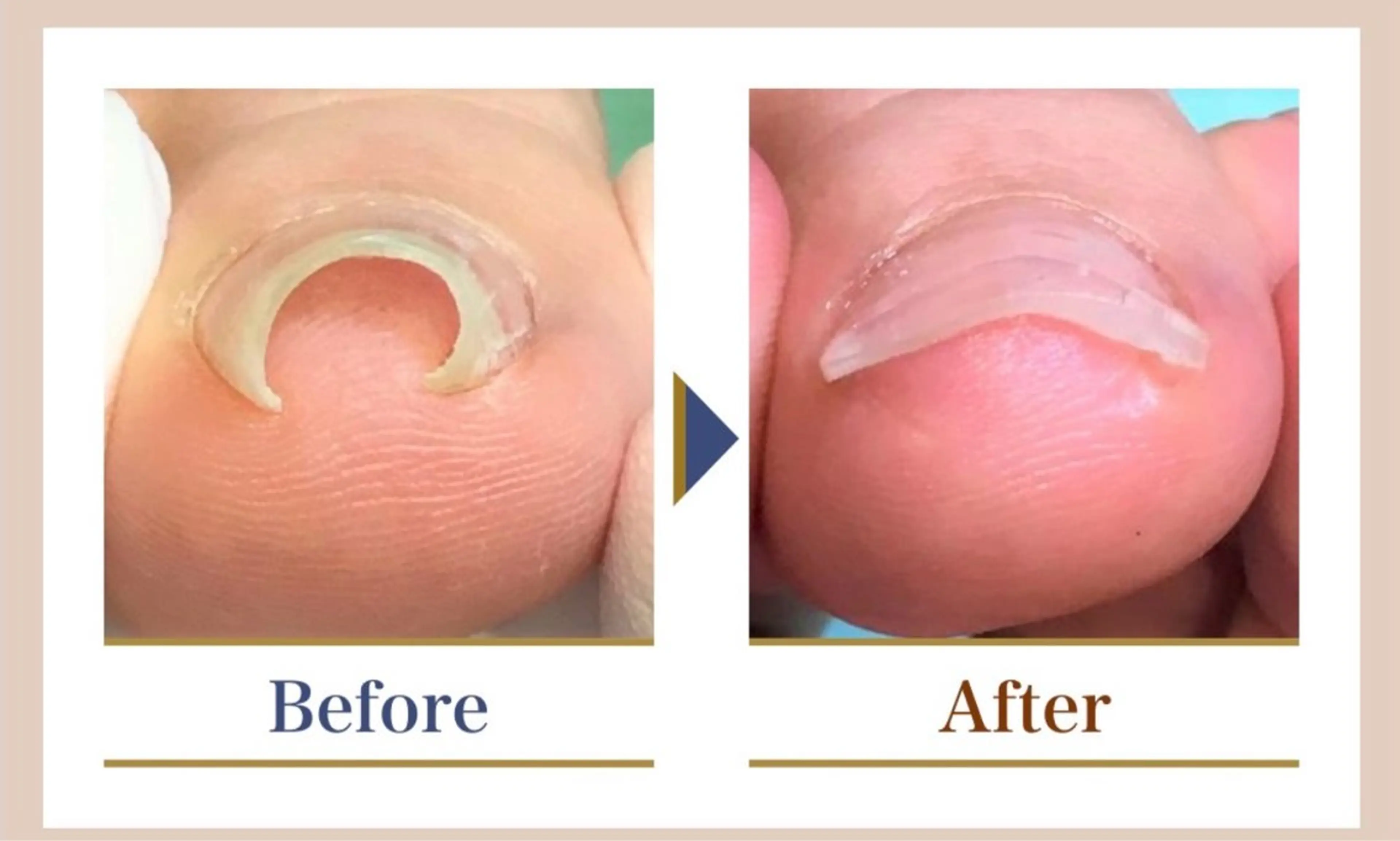 [新規限定]【巻き爪補正2ヵ所】 +【足の爪切りセット】　¥12,650→¥11,000の写真