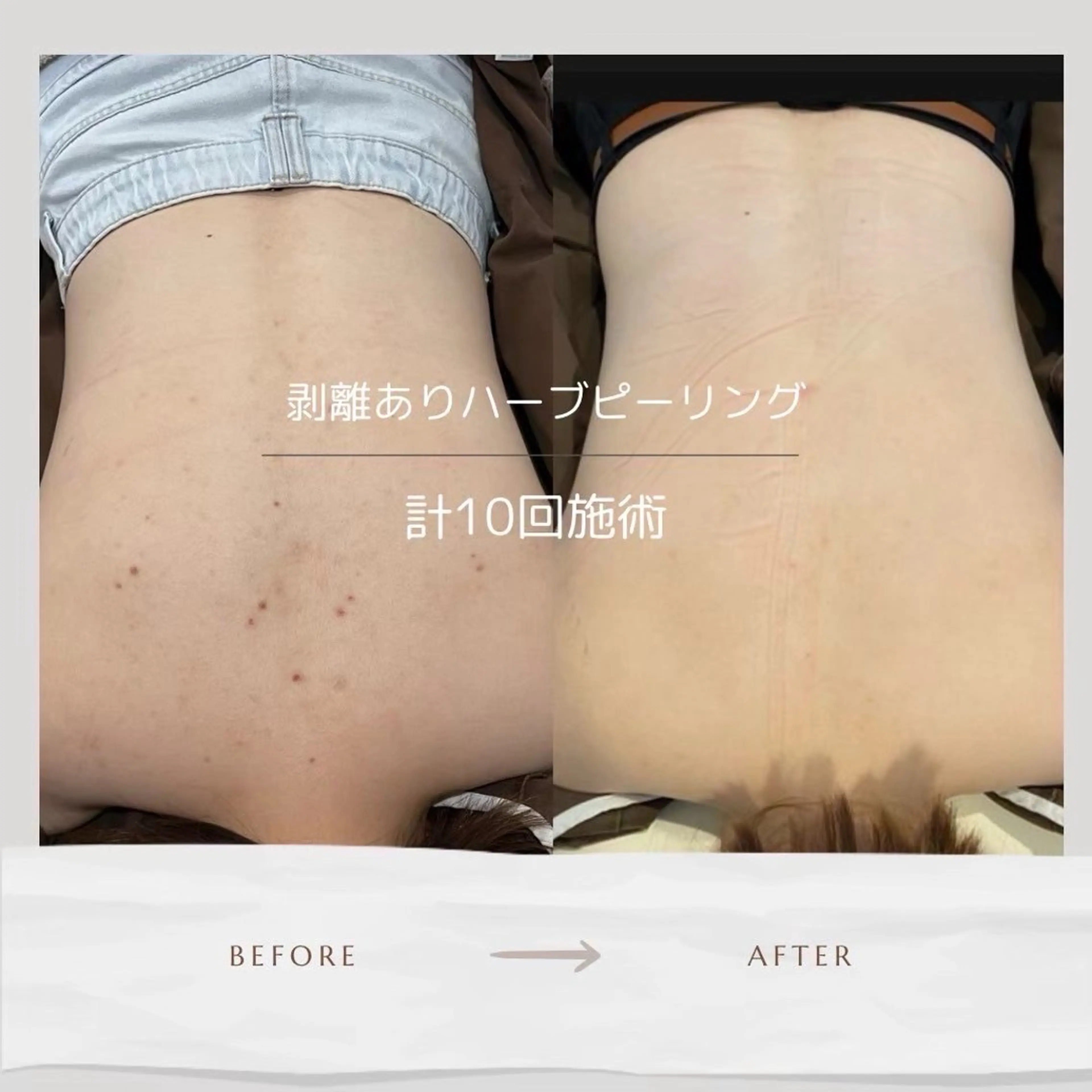 【モニター募集！】人気🌿ハーブピーリング🌿背中上部or下部◎剥離ありなし選べる8回券 50,000円の写真