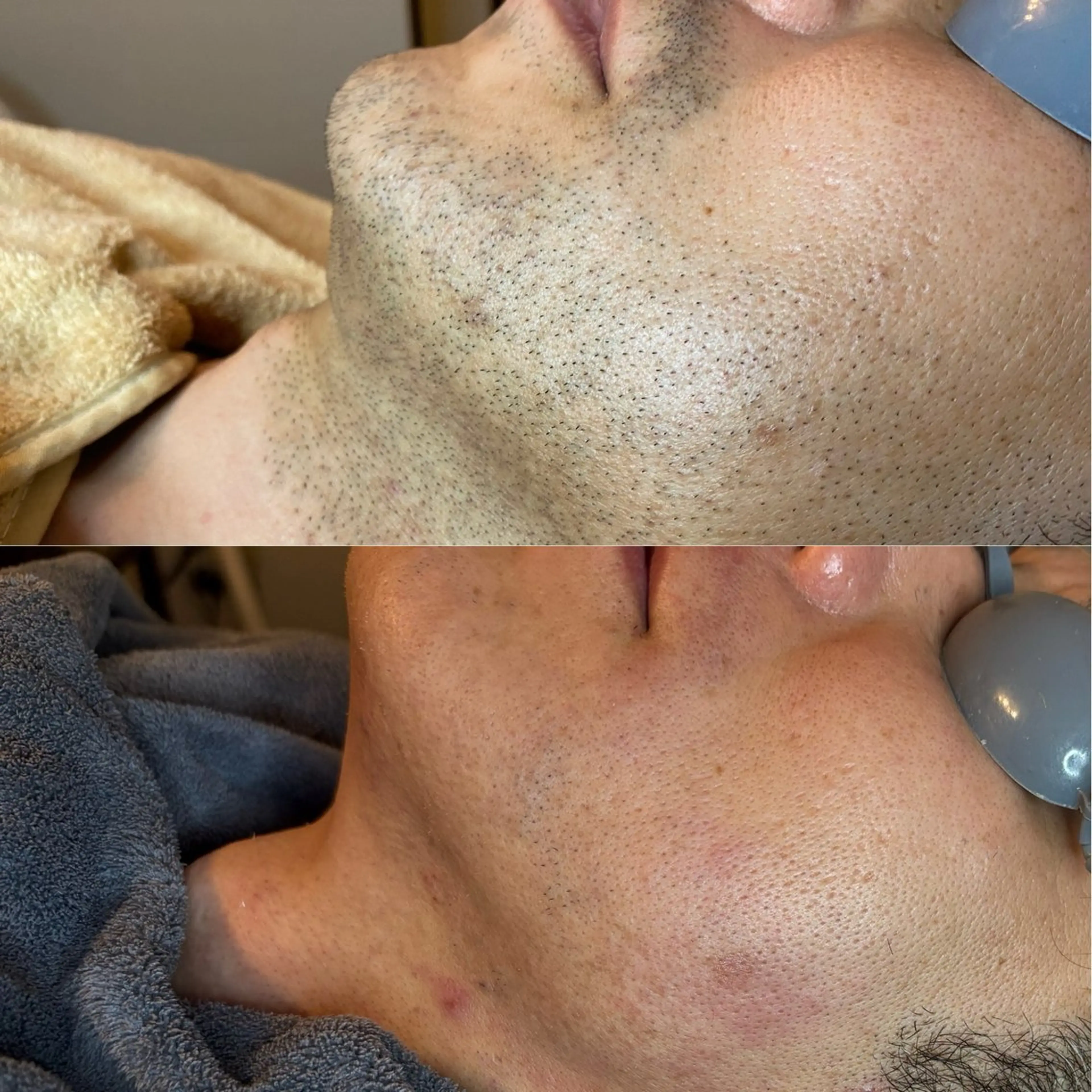 メンズ ハーブピーリング 脱毛専門店ALTOのエステ・リラクイメージ