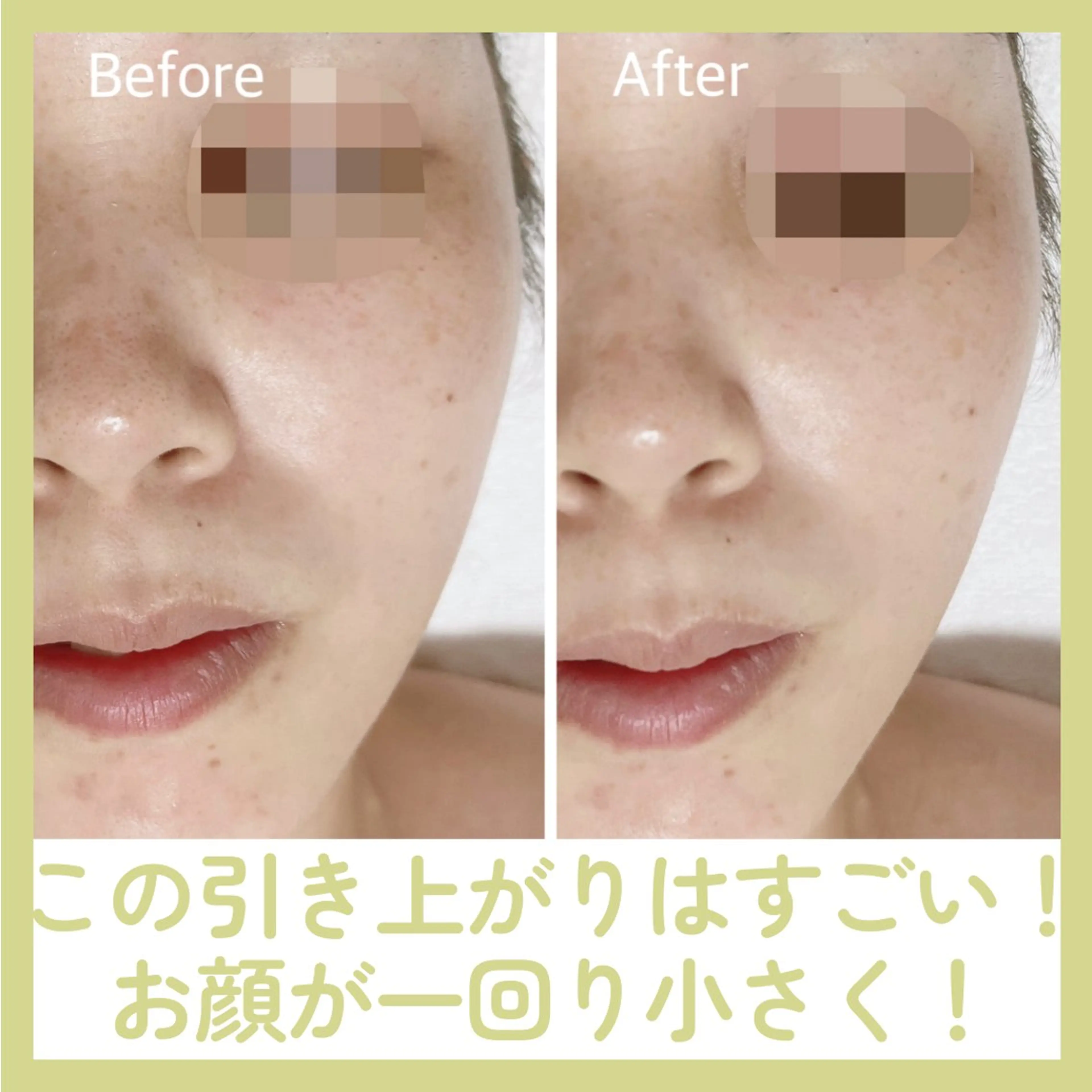 INDIBA フェイシャルの写真