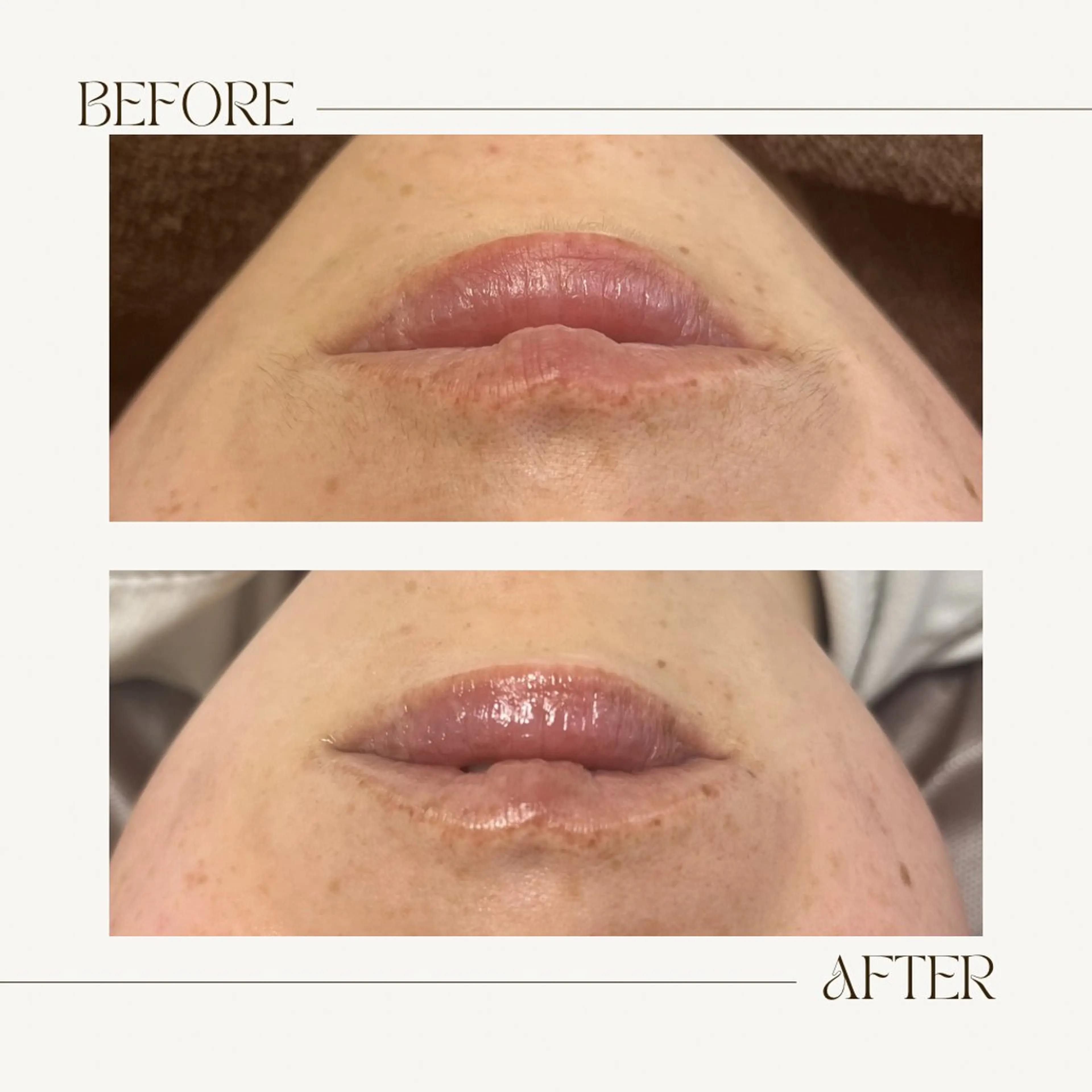 脱毛 1st｜フェイシャル エステ専門店のエステ・リラクイメージ