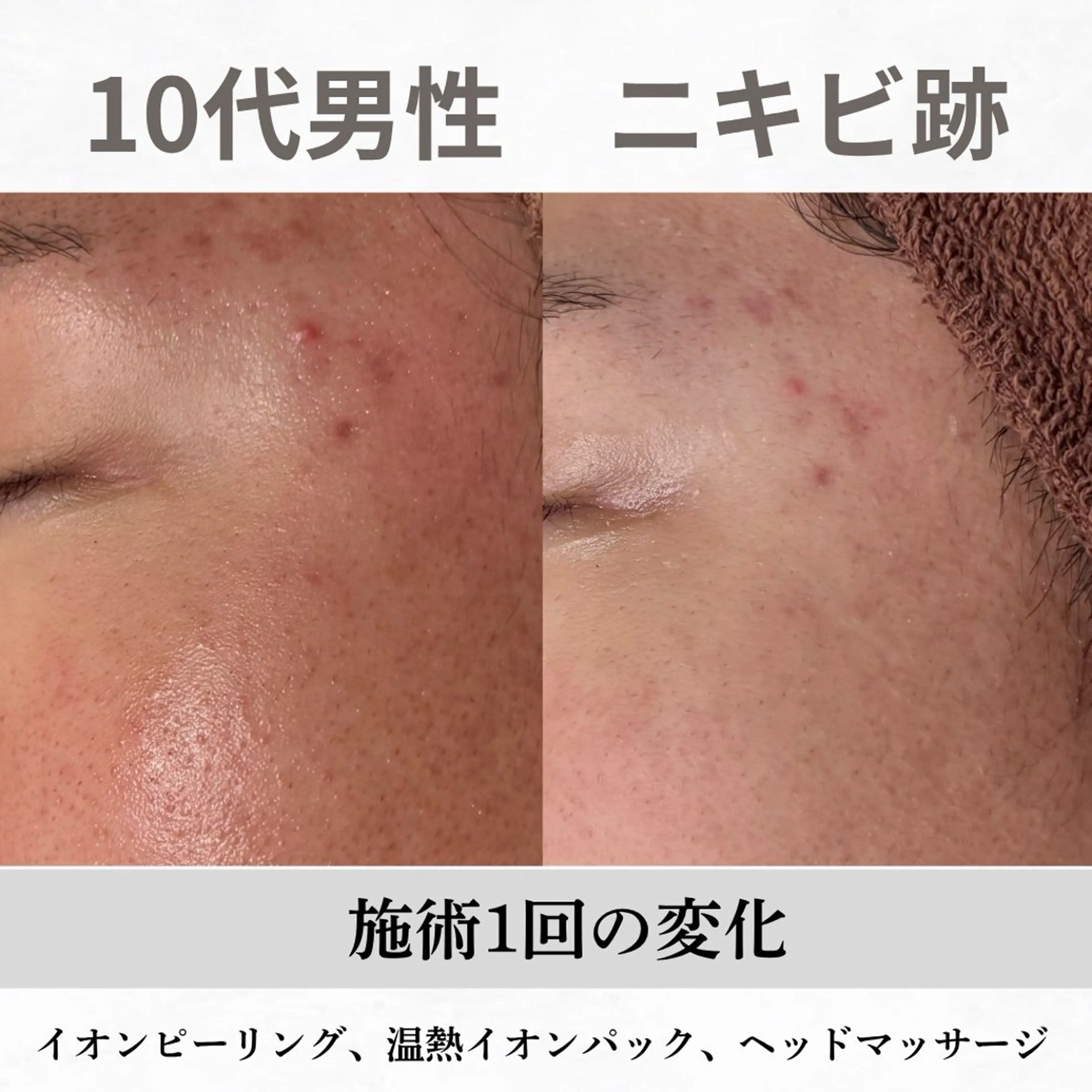 重度ニキビ専門🌷 ダウンタイムなしのエステ・リラクイメージ