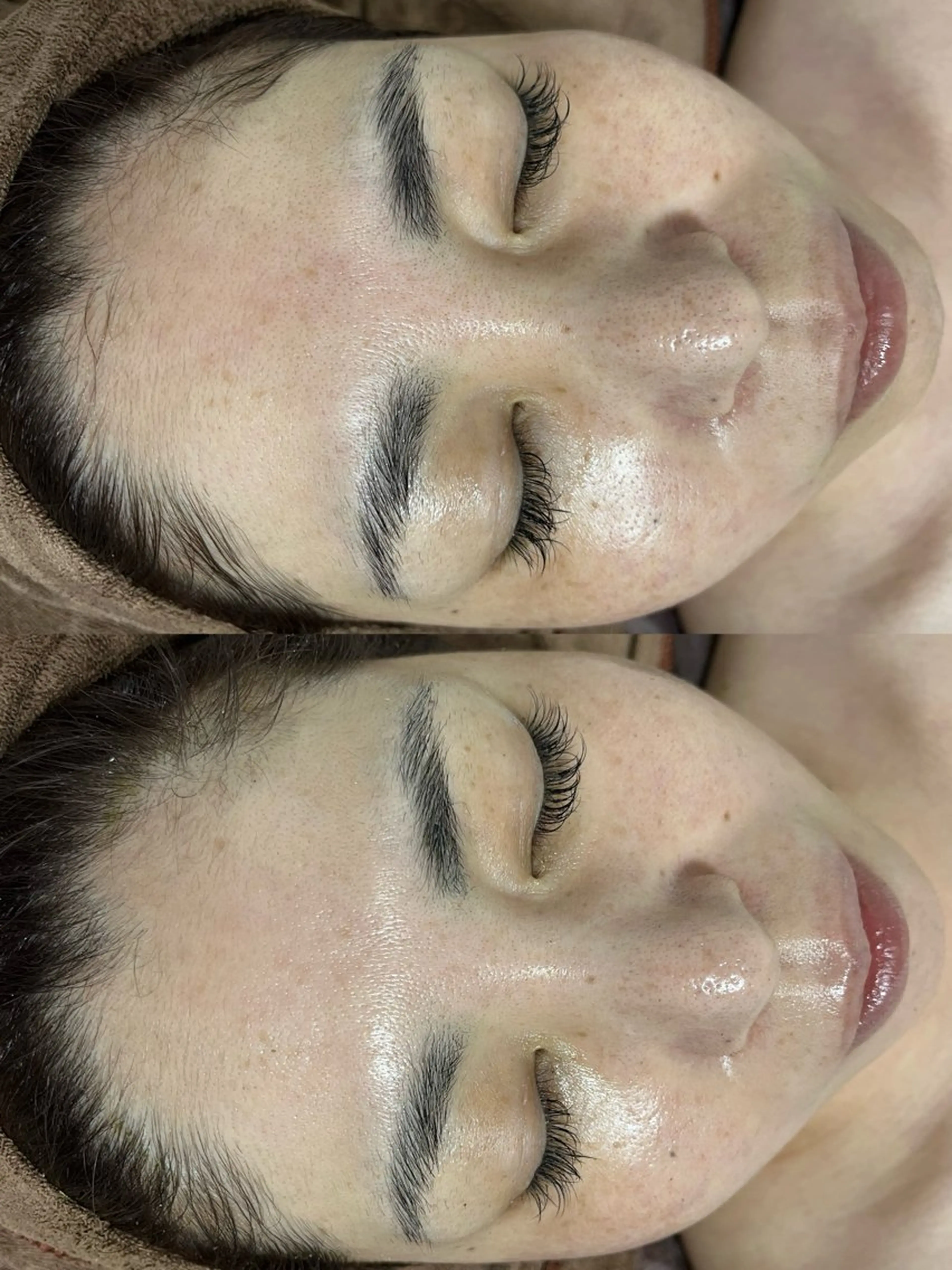 ニキビ／毛穴ケア ハーブピーリングのエステ・リラクイメージ