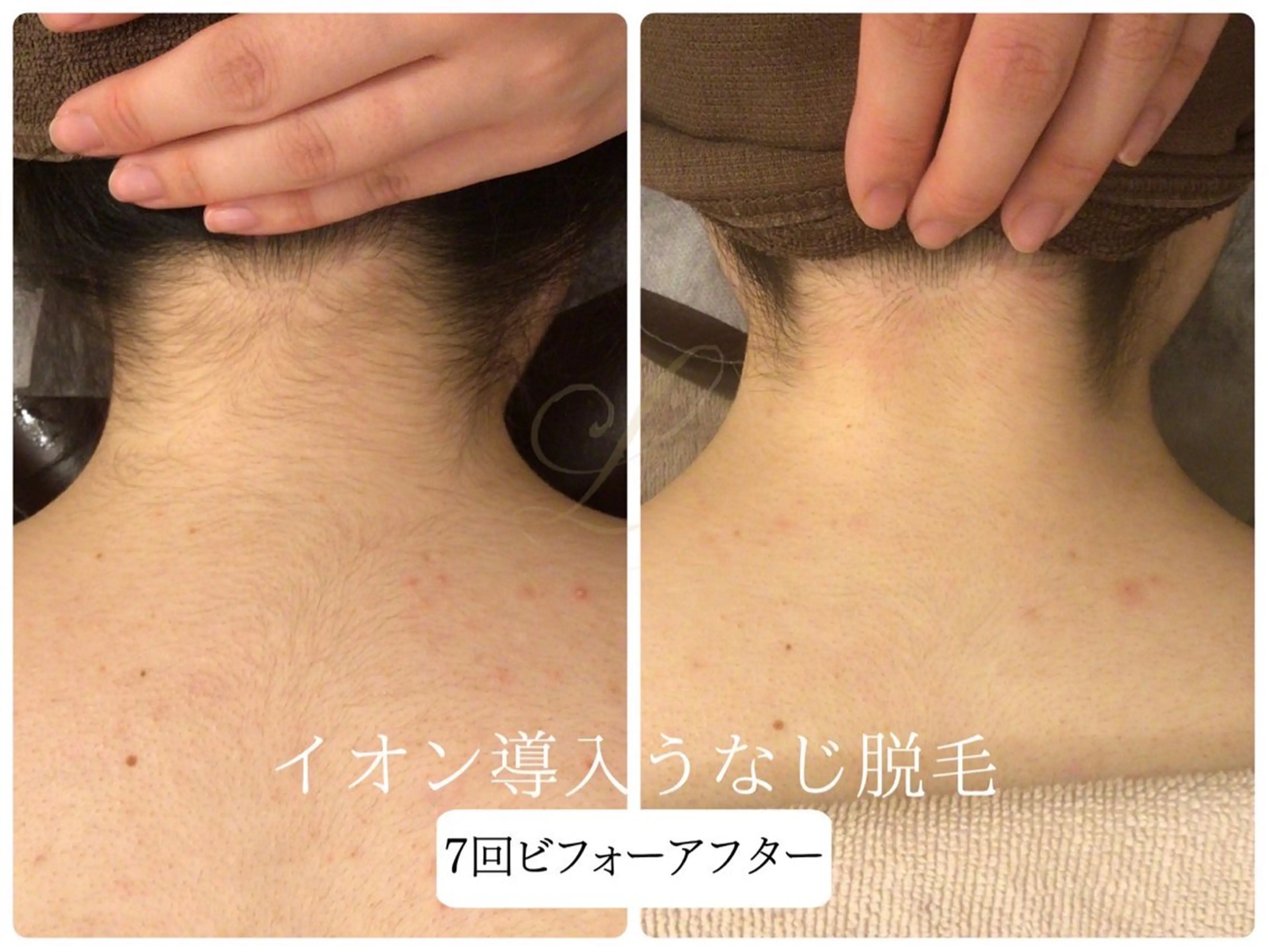 脱毛 Beauty  salon Lino所属・🎀うなじ脱毛🎀 ㅣLino堀江のエステ・リラクイメージ