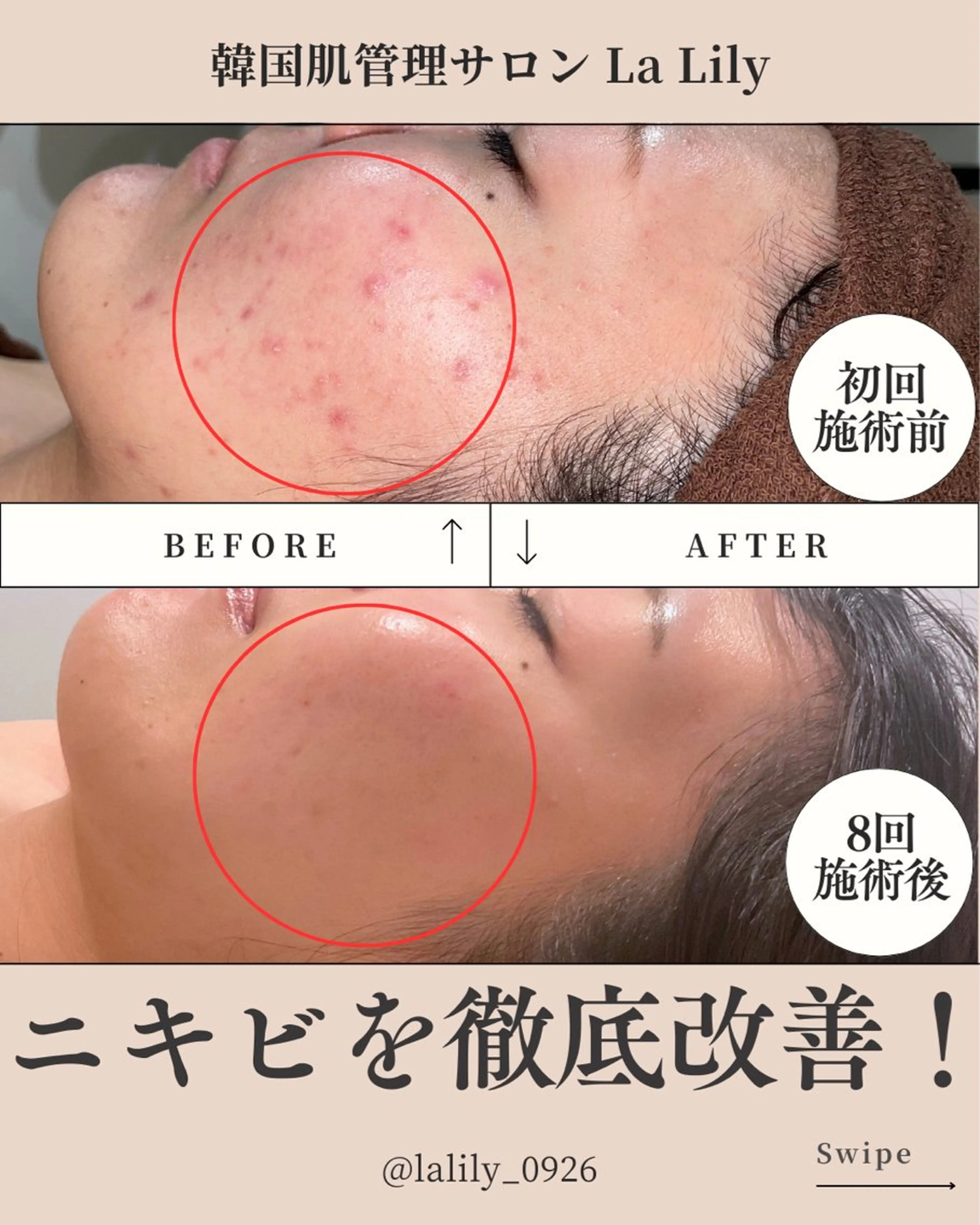 韓国式無針水光施術ミコステラ×毛穴洗浄【ご新規様限定】の写真