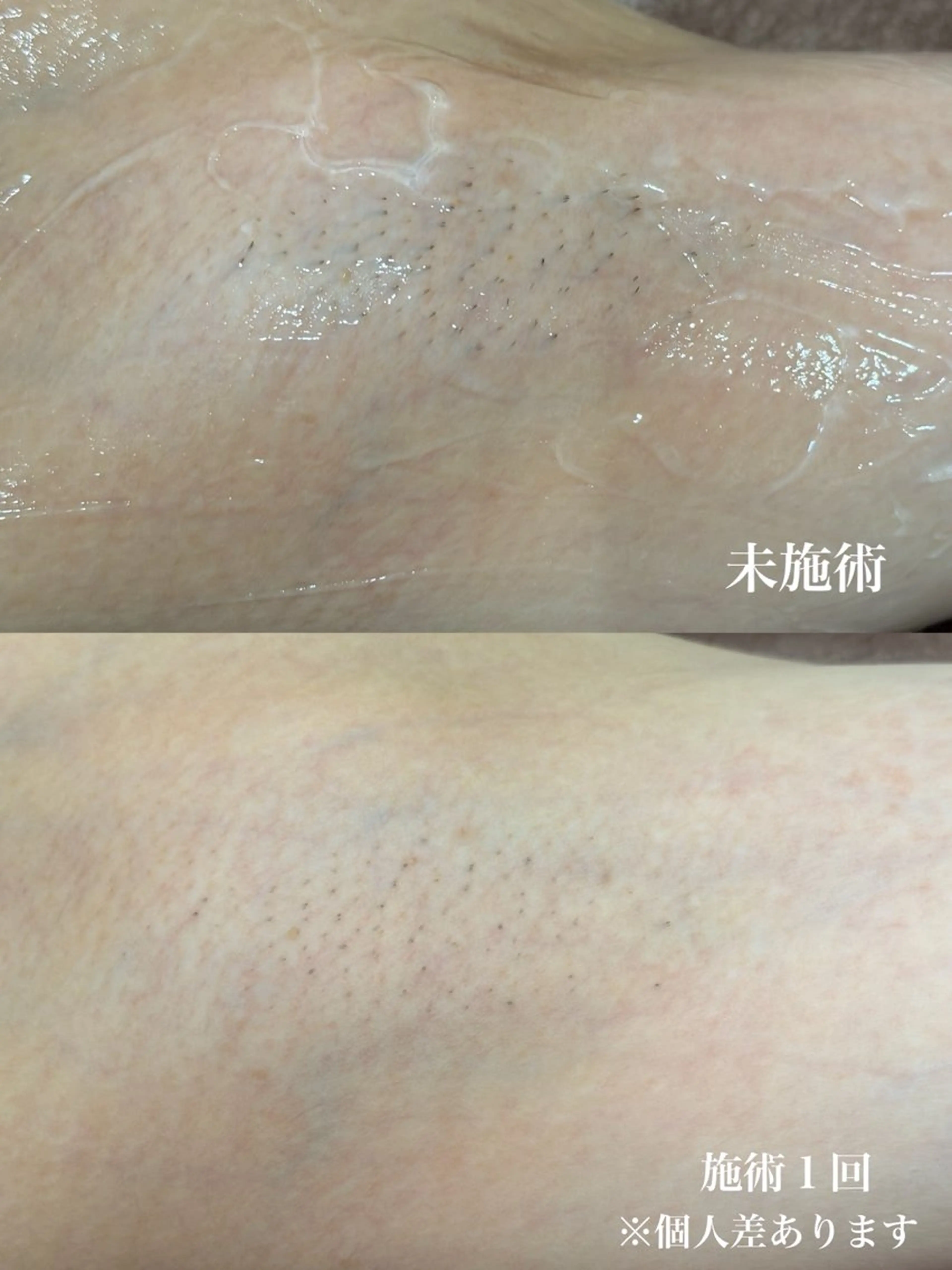 脱毛 muumo まりののエステ・リラクイメージ