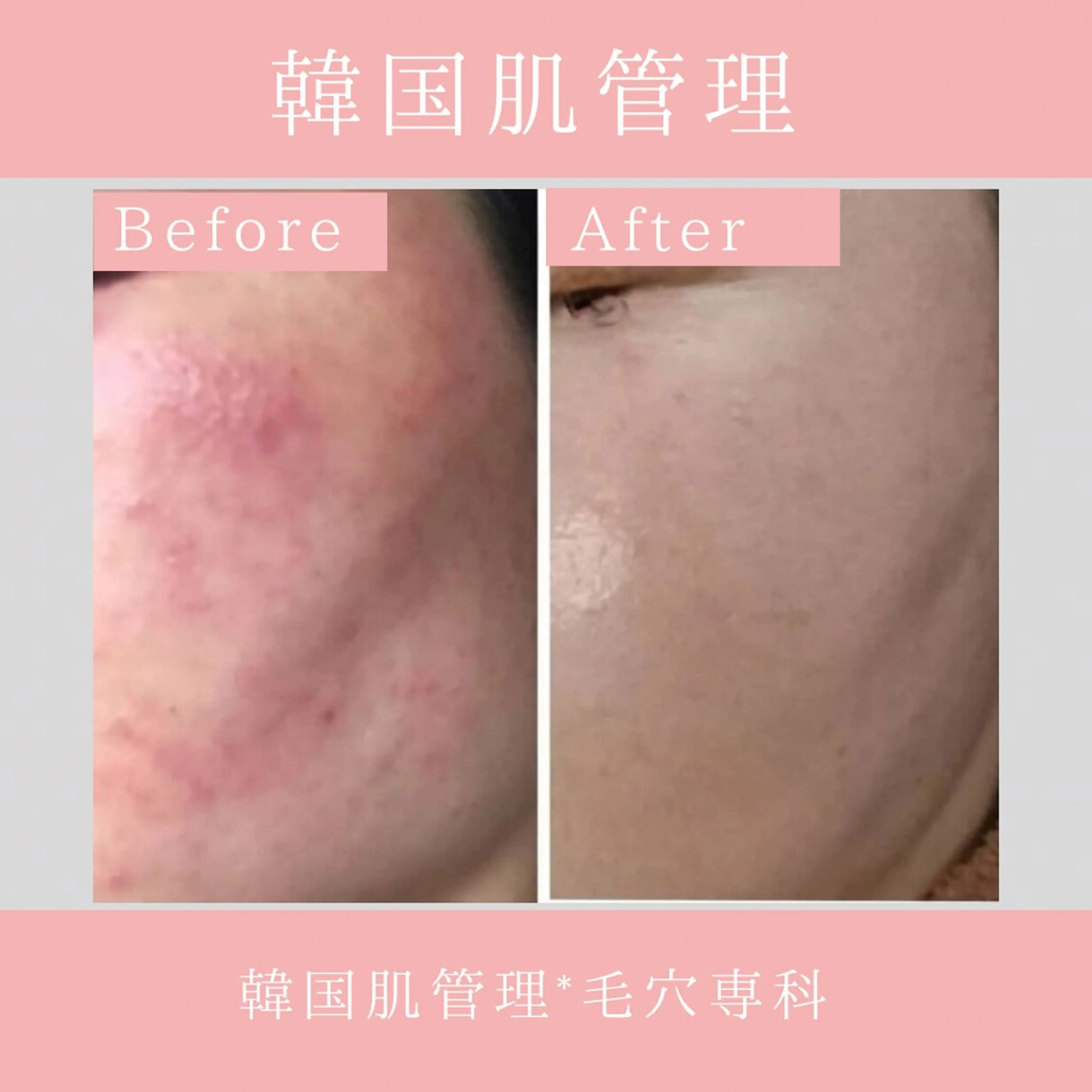 エステ リラク 韓国肌管理 【毛穴専科】のエステ・リラクイメージ