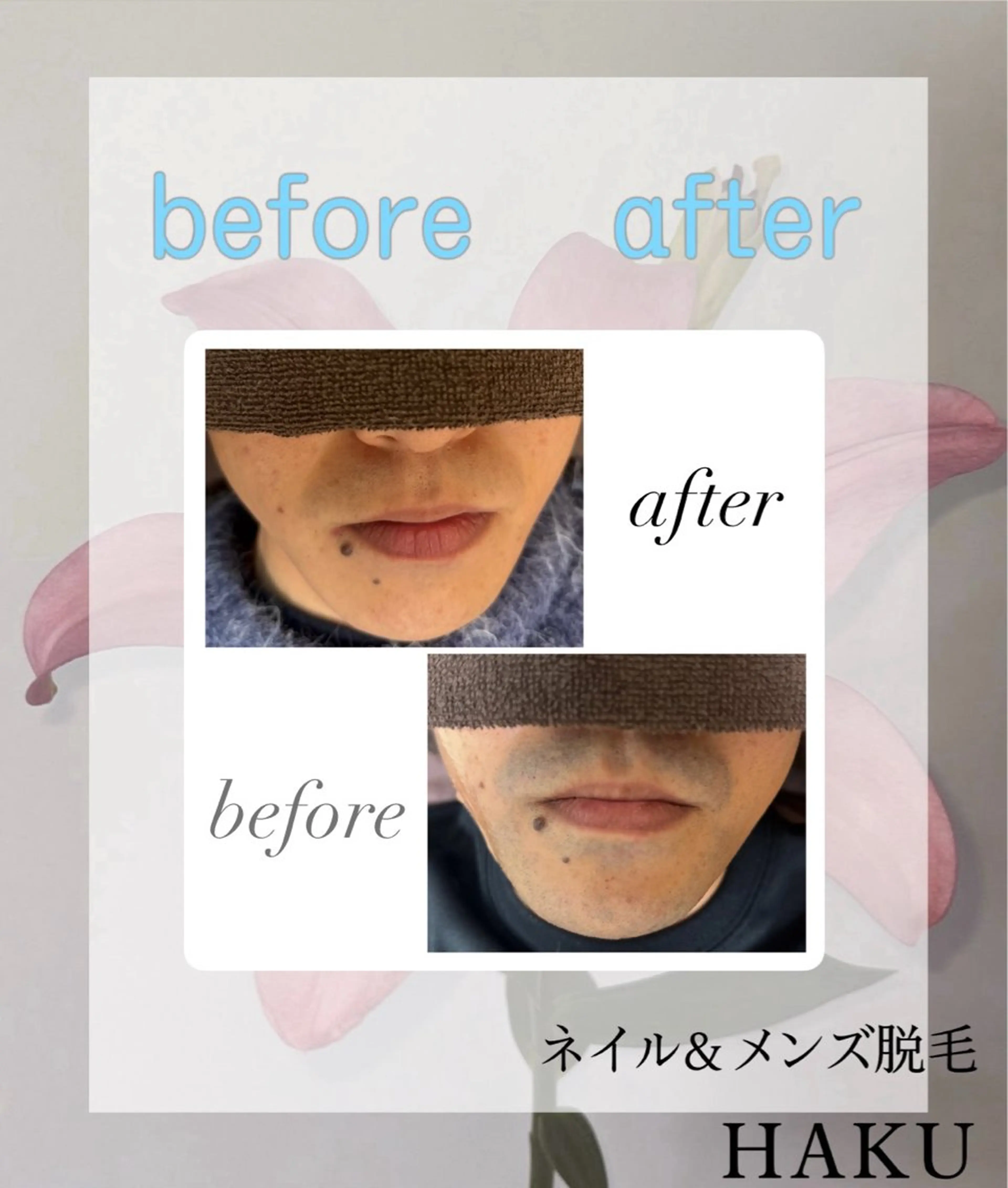 ヒゲ脱毛🧊の写真