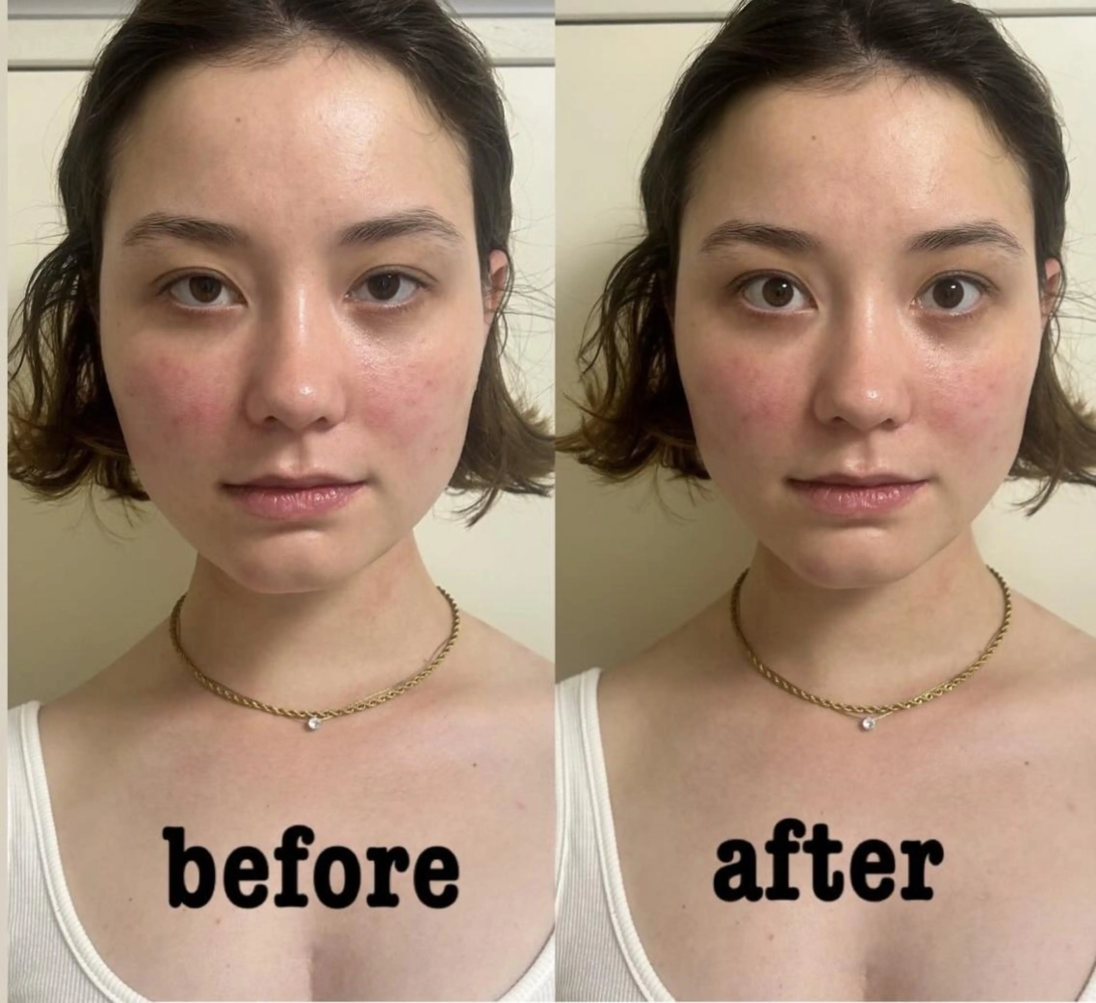 学割👩‍🎓🌸【最強小顔、とにかくスッキリ】✨電気美容鍼＋強力EMS✨/特別価格13800円→5900円の写真