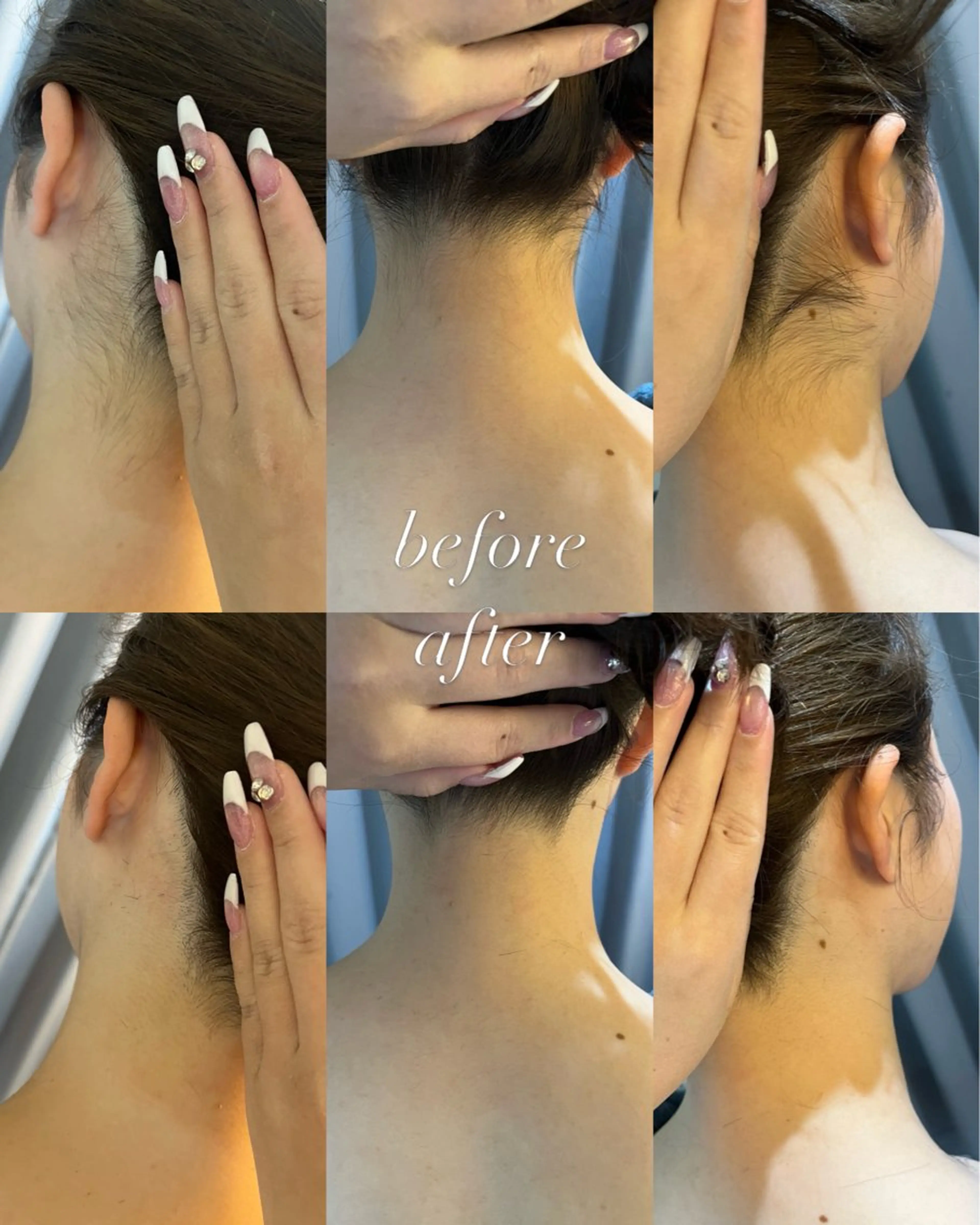 脱毛 うなじ脱毛/美肌脱毛 LABELのエステ・リラクイメージ