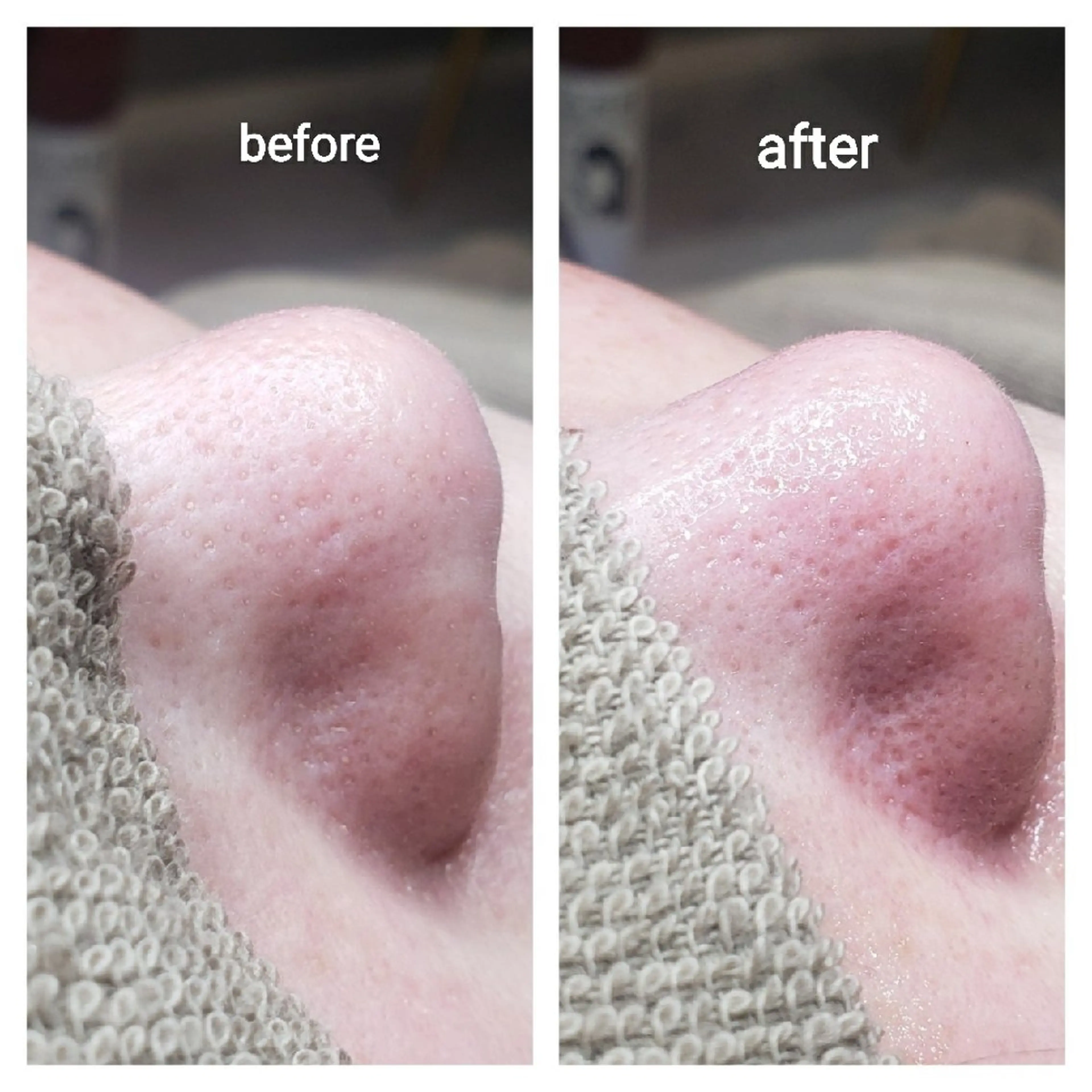 毛穴エクストラクション✨メンズOK　リピーター様の写真