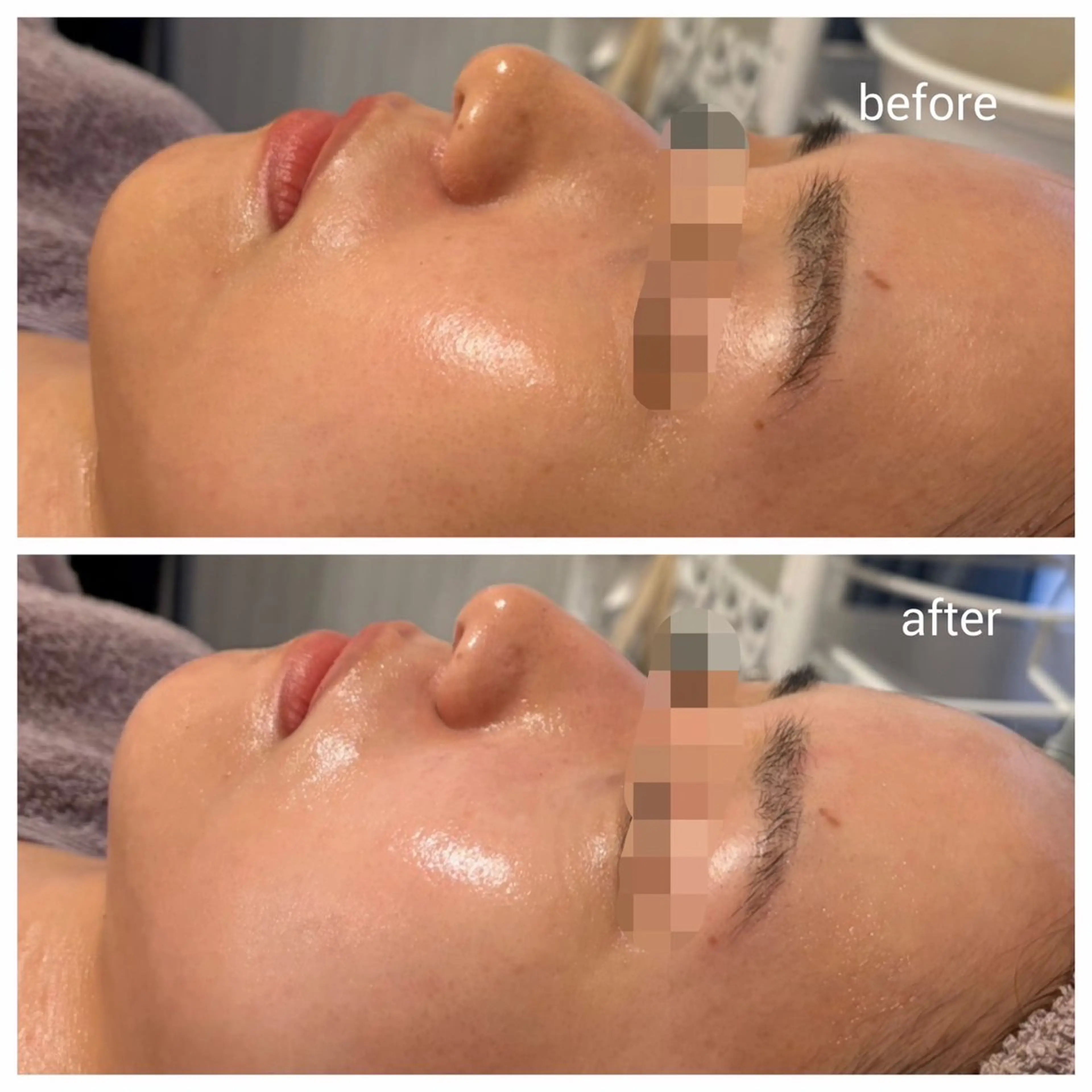 【ハーブピーリング2ｇIPSコース】ニキビ/毛穴/くすみ/シミ/たるみ/どんな肌トラブルも◎の写真